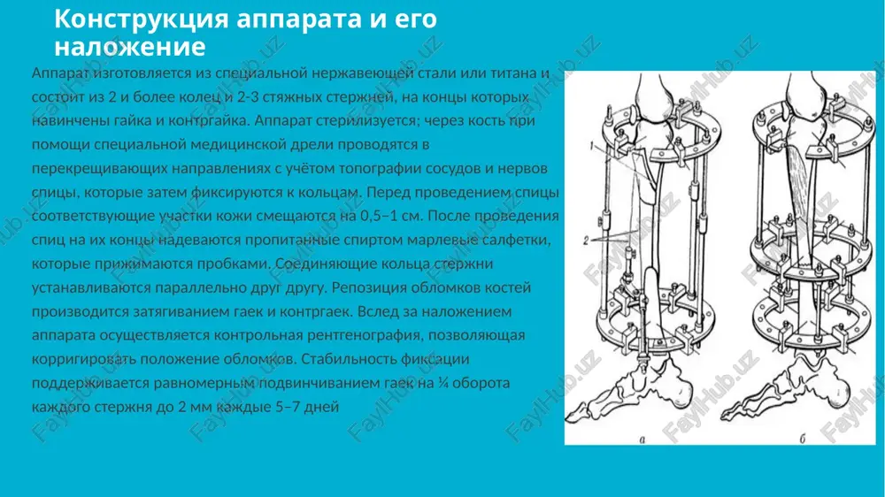 apparat ilizarova - Page 5