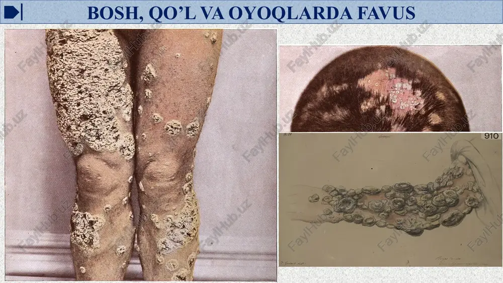 hisi l.tropica var.major hisoblanadi. leyshmaniozning bu xili qishloq va sahrolarda uchraydigan, o'tkir nekrozli, ho'l teri leyshmaniozi deyiladi. teri leyshmaniozi qo‘zg‘atuvchiiarining manbai qum sichqon, kalam ush va boshqa kemiruvchilar hisoblanadi. kasallik phlebotomus iskabtopar chivinlari orqali yuqadi. ular qumsichqonlarni chaqqandan so‘ng yuqumli bo‘lib qoladi. flebotomuslar, asosan, sahroda qumsichqonlar inida yashaydi. kasallikning yashirin davri 1-2 haftadan 1,5-2 oygacha. terining leyshm aniya kirgan joyida pushti rangli papula paydo bo'ladi, u tezda kattalashadi, atrofidagi to'qima qizarib turadi, ammo og'rim aydi. 1-2 hafta o'tgach papula leyshmaniomaning o'rtasida nekroz boshlanadi va kattaligi 10-15 mm, chetlari notekis, shilimshiq, yiring bilan qoplangan yaralar paydo bo'ladi. labaratoriya tashxisi bunda yaradan material olib, surtma tayyorlanadi va romanovskiy-gimza usuli bilan bo'yab, mikroskop ostida ko‘ri ladi. leyshmaniyalar, asosan, jarohatlangan hujayra ichida, ayrim hollarda hujayradan tashqarida ko'rinadi. tekshirishga olingan material fibrinsizlantirilgan qonli agarga ekiladi; serologik reaksiyalardan komplementni bog‘lash va immunofluoressensiya reaksiyalari qo'yiladi. oq sichqonlar terisiga yaradan olingan material surib yuqtlriladi, ya’ni biologik sinamadan ham …