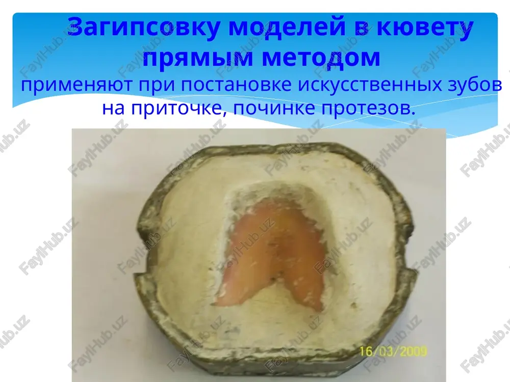 en posle nalojeniya proteza. v etot period patsient ne chuvstvuet protez kak postoronnee telo, a naoborot, chuvstvuet diskomfort bez nego. povtornie korrektsii iz-za travmi slizistoy obolochki mogut bit vizvani:. 1) ploxoy fiksatsiey i stabilizatsiey protezov (travma slizistoy obolochki po krayu proteza, razlitaya giperemiya proteznogo loja);. 2) netochnostyami pri poluchenii slepkov iz-za nepravilnogo vibora slepochnogo materiala -- znachitelnoy kompressiey ili deformatsiey slizistoy obolochki (travma slizistoy, razlitaya giperemiya alveolyarnogo otrostka);. 3) nedostatochno virajennimi okklyuznonnimn kontaktami, nepravilnim raspolojeniem zubov po tsentru alveolyarnogo otrostka (travma po tsentru alveolyarnogo otrostka);. 4) otsutstviem izolyatsii v oblasti ostrix kostnix vistupov (prolejni, iz'yazvleniya v oblasti vistupov, kosix liniy);. 5) otsutstviem izolyatsii (travma v oblasti valika, balans proteza) ili chrezmernoy izolyatsiey nebnogo valika (giperemiya, razrastanie slizistoy obolochki). 6) udlinennim, ukorochennim ili istonchennim kraem proteza;. 7) balansom proteza;. 8) povrejdeniem modeli;. 9) deformatsiey modeli pri pressovke plastmassi n t. d. vrachebnie oshibki oshibki v vibore konstruktsii s'emnogo proteza oshibki v …