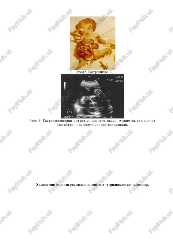 kon zardobidagi alfafetoprotein mikdorini aniqlash, boshqacha aytganda, prenatal diagnostikasiga tug'ma nuqsonlarni ommaviy profilaktikasi o'tkazilgan hollardagina erishish mumkin. tug'ma nuqsonlarni aniqlashdagi qo'shimcha belgilarga e'tibor berish va ularni aniqlash, amaliy jihatdan asosiy yo'nalishi bo'lib, siz bo'lajak pediatrlar diqqatini tortishi kerak. postnatal davrda tug'ma nuqsonlar diagnostikasida utt va kt tekshiruvlari katta ahamiyatli hisoblanadi. ( rasm 13 . pastki ichak tutilishi ) rasm 14. orqa miya churrasida mrt tekshiruvi. rasm 15. orqa miya churrasida mrt tekshiruvi. rasm 16. bosh miya va umurtka pog'onasi mrt va kt tekshiruvlari. bo'yin soxasida usmasimon xosila aniklanadi. rasm 17. diafragmal churrada kt tekshiruvi. ( rasm 18 . bosh miya utt tekshiruvi. tu g'ma gidrotsefaliya. ) ( rasm 19 . bosh miya utt tekshiruvi. tu g'ma gidrotsefaliya. yon qorinchalarnig kengayishi. ) ( rasm 12,13,14,15,16. leda sindromida ichaklar aylanishi buzilishining utt diagnostikasi . ichak tutilishi belgilari bilan birga ichak tutqichi tomirlarining spiralsimon yo'nalishi ko'rinadi. ) rasm 17. to'liq ikkilangan o'ng buyrak …