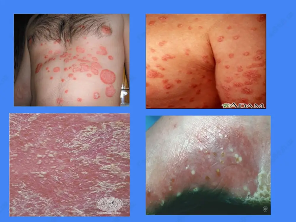 iv psoriaz pustulyoz psoriaz psoriatik eritrodermiya 1. intertriginoz psoriaz-- kukrak yoshidagi bolalarda, kand kasalligiga duchor bulganlarda, revmatizm, semiz kishilarda va kari uta sezgir organizmli kishilarda kuzatiladi. atipik joylashish bilan ya'ni oyok-kullarning va bugimlarning bukuvchi yuzalarida, chov va son burmalari terisida, kultik ostida, kaft va tovonlarda toshmalar toshishi bilan xarakterlanadi. kupincha kichishish va achishish bilan namoyon buluvchi xul va matseratsiyalangan yuzali, kamrok kipiklanuvchi, tuk kizil rangli, anik chegarali ekssudativ, nummulyar papulalar kurinishida namoyon buladi. tabiiy burmalar psoriazi ( intertriginoz) tabiiy burmalar psoriazi ( intertriginoz) tabiiy burmalar psoriazi ( intertriginoz) tabiiy burmalar psoriazi ( intertriginoz) 2. pustulyoz psoriaz—ikki xil turi tafovut etiladi. 1. zumbush tipi—kam xollarda birlamchi kelib chikishi, ammo kupincha vulgar yoki intertriginoz psoriazning transformatsiyasi natijasida kelib chikadi. bu ogir umumiy kasallik bulib, tana xarorati kutarilishi, darmonsizlik va leykotsitoz bilan kechadi. dastlab kuplab disseminatsiyalashgan eritematoz, eritematoz-shishli uchoklar paydo buladi, tezda butun tana terisiga tarkaladi, xar xil figuralar va diffuz och kizil …