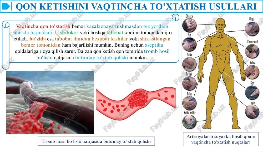 zroq bitishi uchun harorati 60°-70° bo'lgan suv yoki issiq suvga botirilgan tamponlardan foydalanish mumkin (masalan, me'dadan, oshqozondan, qovuqdan qon oqqanda). hozirgi vaqtda sovuqni ma'lum haroratda rejalab beradigan krioapparatlar mavjud. ular parenximatoz, kapillyar qon ketganda keng qo'llaniladi. qon ketishini batamom to'xtatishda hozir lazerlar keng qo'llanilmoqda. qon ketishini to'xtatishning kimyoviy usullari qon ketishini batamom to'xtatishda xirurgik usullarning imkoniyati ko'p bo'lganligi uchun bunda kimyoviy metodlarning ahamiyati ham ortmoqda. hozirgi kunda qonning ivishini oshiradigan moddalardan 10 foizli kalsiy xlorid, kalsiy glyukonat eritmalari, 3 foizli pektin eritmasi va kalsiy xloridning 1 foizli aralashmasi gemofobin, giyohlardan tashkil topgan qon ivishini tezlashtiruvchi moddalar - lagoxilus (krapiva qichitqi o't), bo'y modaron (tisyachelistnik), suv garmdorisi, kalina po'stlog'i eritmalari va boshqalar ishlatiladi. kapillyarlardan qon ketganda, ularning devorini mustahkamlovchi moddalardan 12,5 foiz etamzilat (ditsinon), 0,025 foizli adro ksan ishlatiladi. qonning fibrinolitik faolligi oshganligi natijasida qon ketishi ro'y bergan bo'lsa, shuningdek, o'pka, oshqozon osti va buqoq bezlari, gipoplastik anemiya operatsiyalaridan oldin, yo'ldosh …