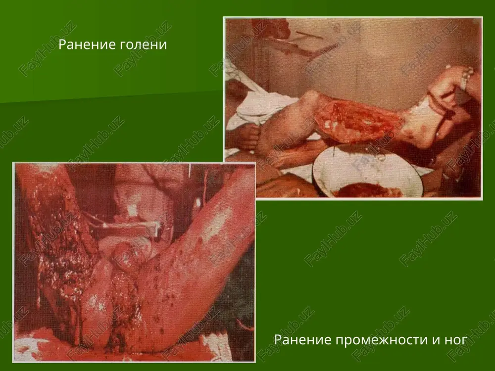 simo ot ploshadi otsloyki. operatsiya – svobodnaya kojnaya autoplastika po v.k. krasovitovu 1-iy etap – podgotovka retsipientnogo loja, t.e.tshatelnaya pxo rani 2-oy etap – podgotovka «donorskogo» kojnogo loskuta. b) otsloyki posloynogo kojno-podkojno-fastsialnogo loskuta: pri ogranichennoy otsloyke tkaney (do 200 sm²) – podshivanie loskuta. pri obshirnoy otsloyke – otsechenie loskuta, pxo rani s pervichnoy svobodnoy kojnoy autoplastikoy. neognestrelnie perelomi kostey konechnostey zakritie otkritie: i tip – chistaya rana dlinoy menee 1 sm ii tip – rana 1-5 sm, no bez znachitelnogo povrejdeniya myagkix tkaney iii tip – rana bolee 5 sm s obshirnim povrejdeniem myagkix tkaney: a – kostnie otlomki v meste pereloma zakriti nadkostnitsey i myagkimi tkanyami v - kostnie fragmenti obnajeni vsledstvie obshirnogo razrusheniya myagkix tkaney s – perelom soprovojdaetsya narusheniem krovoobrasheniya, trebuyushim revaskulyarizatsii konechnosti otkritie polifokalnie segmentarnie perelomi, razrusheniya segmentov konechnostey, ognestrelnie perelomi, perelomi s povrejdeniem magistralnix sosudov i perelomi u postradavshix, pomosh kotorim okazivaetsya v sroki bolee …