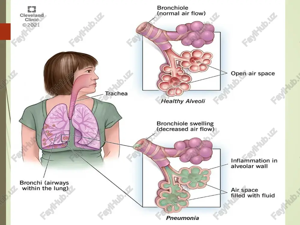 omitsin, yarimsintetik makrolidlar, azitromitsin ftorxinolonlar pnevmoniyani davolashda qo'llaniladigan antibiotiklar dozasi antibiotiklar nomi chiqarilish dozasi qo'llanilishi tabiiy penitsillin: benzilpenitsillinni natriyli tuzi 1 000 000 – 2 000 000 ed har 6-8 soatda (m/o, v/i) aminopenitsillinlar: ampitsillin amoksitsillin 1,0 – 2,0 g 500 -1000 mg har 6-8 soatda (m/o, v/i, ichishga) har 8 soatda (ichishga) himoyalangan penitsillinlar: ampitsillin+sulbaktam augmentin (amoksitsillin+klavulanat kislota) piperatsillin/tazobaktam tikartsillin+ klavulanat k-ta oksatsillin 1,5 – 3,0 (1 g ampits. + 0,5 g sulbaktam.) 1,2 g (500 mg amoksits. + 125 mg klav. kislota) 625 mg 150-300 mg/kg 1,2 g (1,0 g tikar. + 200 mg klav. kislota) 0,5 g har 6-8-12 soat (m/o, ichishga) har 12 soatda (ichishga) har 8-12 soatda (m/o, v/i) har 8 soatda (m/o, v/i) har 4-6 soatda (ichishga, m/o, v/i) tsefalosporinlar i-avlodi: tsefazolin (kefzol) tsefalotin (keflin) tsefaloridin (tseporin) tsefapirin (tsefadil) tsefaleksin (tseporeks, oratsef) tsefadroksel (duratsef) 0,5-1,0 g 0,5-1,0 g 0,5-1,0 g 0,5-1,0 g 0,25 g …