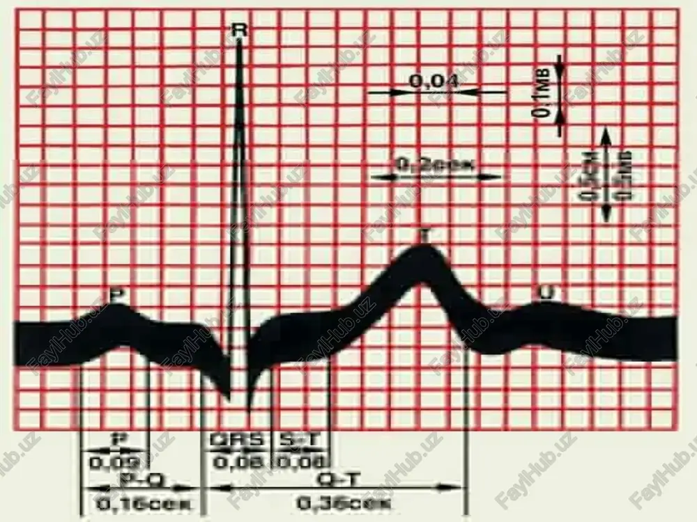 – bo’lmachadan qorinchaga impulslar o’tishi buzilganida yuzaga keladi. 3 darajaga bo’linadi. sinoaterial blokada 1 – darajali blokada - uning klinik belgilari bo’lmay u faqat ekg orqali pq oraliqning 0.3-0.4 sekunddan ko’proq uzayishi av-blokada i daraja av-blokada ii- daraja, i va ii tip 2 – darajali atrioventikulyar blokada - * ashof – tavar tugunchasi va gis bog’lami orqali bo’lmachadan qorinchaga impulslar o’tishi qiyinlasha borib * p-q orqali uzayib boradi va natijada impulslardan biri bo’lmachalardan qorinchalarga yetib bormaydi ekgda qrs kompleks qayd qilinmaydi. * shundan so’ng yana o’tkazuvchanlik qayta tiklanib impulslar normal o’ta boshlaydi * bir necha muddatdan so’ng o’tkazuvchanlik yana buziladi * p-q oraliq uzayib boradi * r tishchadan keyin uzun diastola xosil bo’ladi samoylov – venkebax davri * ekgda p tishchalar soni qorincha qrs sonidan ko’p bo’lib, ular o’rtasidagi munosabat: 2:1; 3:1, va hok. - to’liq bo’lmagan yurak blokadasi bo’lmachalardan qorinchalarga impulslardan 2 yoki 3-si o’tadi. 3 – darajali blokadalar …