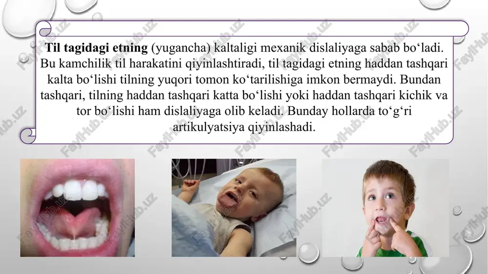 z chuqurcha paydo bo‘ladi, shu chuqurchadan chiqqan havo oqimi til uchini titratib o‘tadi va titroq tovush hosil bo‘ladi. ovoz paychalari jipslashib titraydi va chiqayotgan havo oqimi kuchli bo‘ladi. rotatsizmning quyidagi turlari mavjud: velyar rotatsizm (grekcha velum-yumshoq tanglayning pastki chetiga yaqinlashadi va u yerda oraliq (tirqish) hosil bo‘ladi. shu oraliqdan o‘tayotgan havo oqimi yumshoq tanglayda tartibsiz titrash (vibratsiya) hosil qiladi. natijada ovozga qo‘shilib shovqin chiqadi. uvilyar rotatsizm (grekcha uvula-tilcha), bunda til uchi tebranishi o‘rniga, faqat tilcha tebranadi. kucherskiy rotatsizmi-bunda til uchi tebranmay, lablar jipslashib tebranadi. yon rotatsizm, bunda til uchi tebranishi o‘rniga, tilning yon tomoni tebranadi, natijada noaniq r tovushi hosil bo‘ladi. amaliyotda pararotatsizmni quyidagi turlari uchraydi, ya’ni r tovushi quyidagicha tovushlar bilan almashtiriladi rl; ry(j); rya. rotatsizmga anatomik kamchiliklardan til tagidagi yuganchaning kaltaligi; tor va baland tanglay, haddan tashqari ingichka til sabab bo‘lishi mumkin. lambdatsizm-(grekcha lambda harfini nomidan olin­gan bo‘lib, l tovushini bildiradi). –l tovushining talaffuzidagi kamchilikdan iborat. l tovushining …