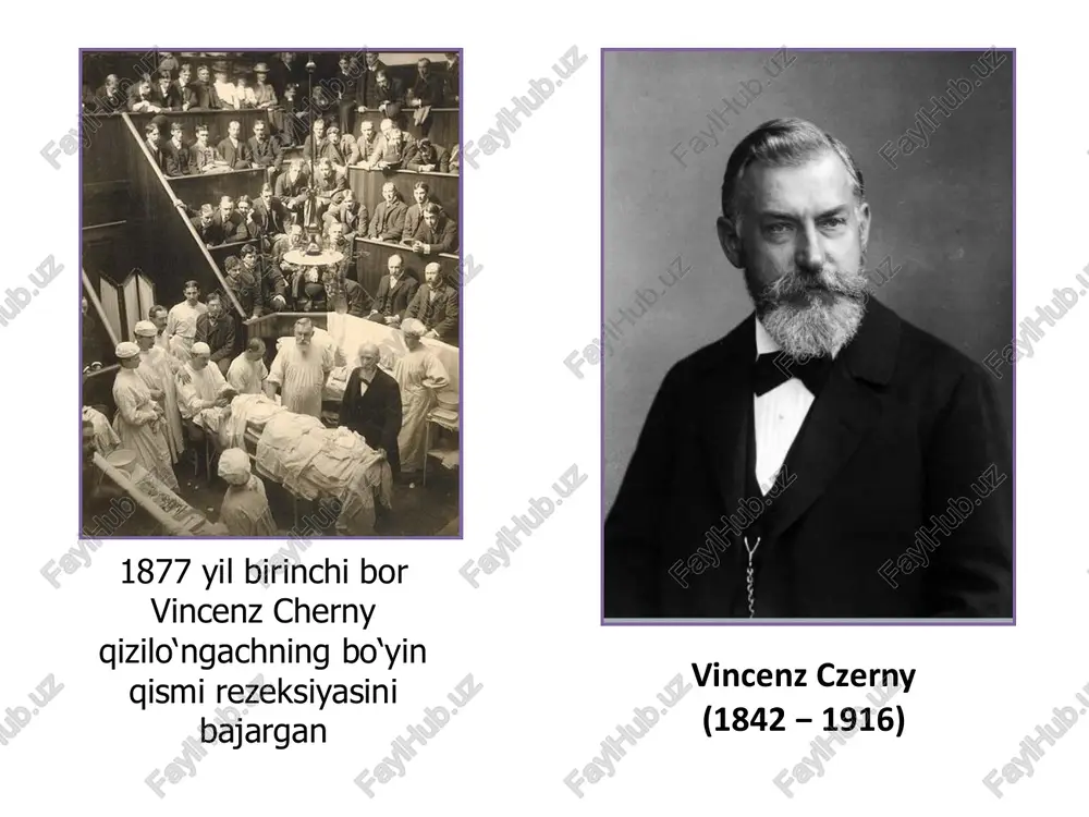 sib olish reflyuks-ezofagit tasnifi • i. birlamchi • qizilo‘ngach va oshqozon motorikasini nerv va peptid (gastrin, gistamin, motilin va boshqalar) regulyasiyasini birlamchi buzilishi • ii. ikkilamchi • diafragma qizilo‘ngach teshigi churralarida, privratnik stenozida, oshqozon yara kasalligida, xoletsistitda, qorin bo‘shlig‘i katta xajmli o‘smalarda, assitda, xomiladorlikda, oshqozon rezeksiyasidan so‘ng, sklerodermiyada va boshqalarda • iii. og‘irlik darajasiga qarab (savari va miller endoskopik klassifikatsiyasi, 1978) kardiospazm davrlari (b.v. petrovskiy) i davr – kardiyani funksional doimiy bo‘lmagan spazmi, qizilo‘ngach kengayishi kuzatilmaydi ii davr – kardiyani stabil spazmi, qizilo‘ngach keskin bo‘lmagan kengayishi bilan iii davr – kardiya mushak qavatining chandiqli o‘zgarishi, qizilo‘ngach keskin kengayishi bilan iv davr – kardiya keskin stenozi, qizilo‘ngach dilyatatsiyasi (ko‘pincha s-simon), ezofagit belgilari bilan kardiospazm ii bosqich iii bosqich iv bosqich kardiospazmni davolash usullari nissen operatsiyasi kardiospazmni davolash usullari qizilo‘ngach axalaziyasi axalaziyada qizilo‘ngach shaklining o‘zgarishi qizilo‘ngach axalaziyasi uchun xos bo‘lgan belgilar 1. disfagiya 2. regurgitatsiya 3. og‘riq (og‘riqlar ovqat qabul qilish bilan …