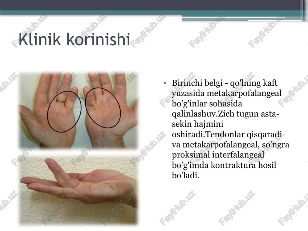 dyupyuitren kontrakturasi - Page 5