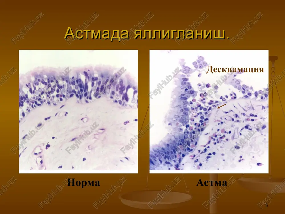 nafas olish faoliyatini monitorda kuzatish konda va chikarilayotgan xavo tarkibidagi gazlar sostavini aniklash konda kislota-ishkor muvozatini aniklash bronxoskopiya upkaning suniy ventilyatsiyasi * bronxial astmada balgam: balgamning bir sutkada 500 ml dan va undan kup ajralishi ba'zi bir mukolitiklar (bisolvon, atsetiltsistein) ta'sirida, nafas yulining utkir virusli kasalligida va upka alveolyar rakida kuzatiladi. balgam shillikli, shishasimon va kuyuk buladi kup mikdorda eozinofillar, kurishman buramasi, sharko-leyden kristallari aniklaniladi. * bronxial astma davosi. dorilar ikki guruxga bulinadi: shoshilinch yordam kursatish uchun (kiska ta'sir kiluvchi bronx-kengaytiruvchilar) bazis davolash uchun (yalliglanishga karshi va uzok ta'sir kuluvchi bronx kengaytiruvchilar) * 1. bemorlarni ukitish 2. ogirlik darajasini baxolash va kuzatish 3. xavf omillari ta'siridan saklanish 4. surunkali bemorlarni davolash rejasini tuzish: kattalarda va bolalarda 5. xurujlarni davolash rejasini tuzish 6. keyingi regulyar kuzatuvni amalga oshirish astmani davolashda 6 etapli dastur * * surunkali astmani davolashda pog'onali yondashuv . * 1-kadam bronxodilyatatorlar talabga karab kiska ta'sir etuvchi v2-stimulyatorlar(sutkasiga 1 …