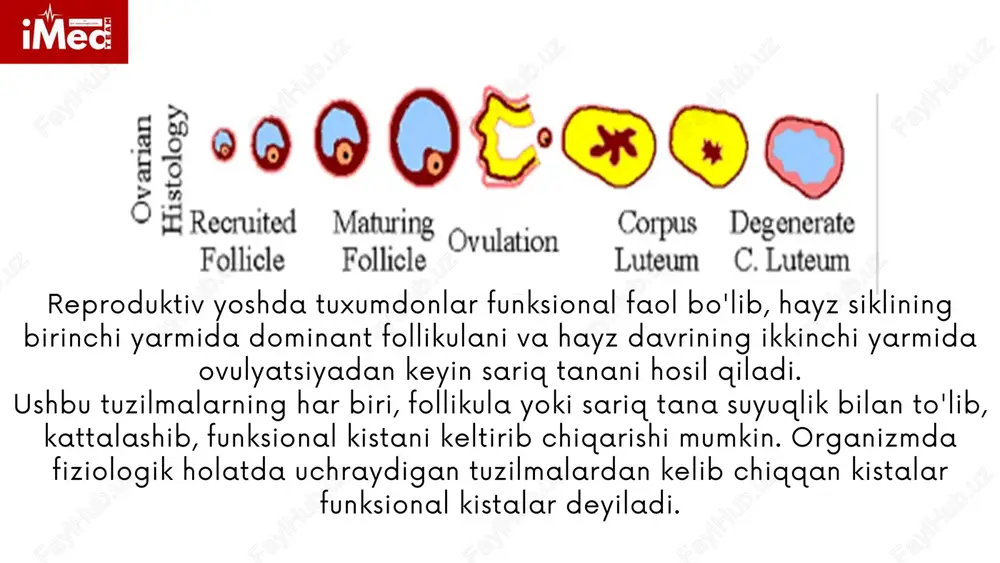 osan utt ga asoslanadi. o'z vaqtida tashxis qo'yilmasligi bemorda yiringli hosila yorilib ketishi natijasida pelvioperitonit hamda peritonitga olib kelishi mumkin. davolash statsionar sharoitda asosan operativ davo bilan bo`ladi. bunda bitishmalar bartaraf etiladi, yiringli hosila olib tashlanadi. operatsiyadan keying davrda antibacterial hamda infusion terapiya davom ettiriladi. endometrioid (shokolad) kistasi odatda kichik o'lchamli, qalin quyuq jigarrang suyuqlikni o'z ichiga oladi. bachadon bo'shlig'idan bachadon naylari bo'ylab kelgan endometriy hujayralarning tuxumdonga implantatsiyasi natijasida kista paydo bo'ladi. endometrioid kista tuxumdonlar yuzasida rivojlanadi va hayz davrining hayz qonining chiqarilishiga qadar barcha bosqichlaridan o'tadi va hayz davrida hayz qoni kista ichida to`planadi. tuxumdon atrofida qorin parda va qo`shni a'zolar bilan aseptik yallig'lanishli bitishmalar hosil bo'ladi. endometrioid kistasi klinik jihatdan endometrioid kistaga hayz paytidagi og'riq sindromi xosdir. hayz sikli bilan bog'liq og'riq hayz paytida ortadi, hayz ko'rgandan keyin susayadi yoki yo'qoladi. endometrioid kistaning kapsulasi yorilib ketganda, "o'tkir qorin" klinikasi rivojlanadi. klinikasi: endometrioid kista uttda ko`rinishi endometrioid kista laparoskopik …