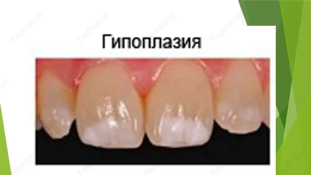 o’yiqsiz bo’ladi.oldinlari getchinson va furnye tishlari tug’ma sifilisga xos deb hisoblangan.bu belgilar tug’ma sifilis triadasiga: parenximatoz keratit,tug’ma karlik,getchison tishlari kiradi.keyinchalik tekshirishlar natijasida tishning bu anomaliyasi boshqa holatlardayam uchrashi aniqlandi. pfluger tishi- bunda birinchi molyarlarning bo’yin qismi chaynov qismiga qaraganda qalinroq,domboqlari rivojlanmagan,tishga konusimon shakl beradi. differensial diagnostika.gipoplaziyani boshlang’ich va yuza karieslardan dif.diagnostika qilish kerak bo’ladi.kariesda oq dog’ yakka tishning bo’yin qismida, gipoplaziyada esa oq dog’lar ko’plab bo’lib,tish tojining istalgan yuzasida joylashgan bo’ladi.gipoplaziyada dog’lar 2% li metilen ko’ki bilan bo’yalmaydi. yuza kariesdan gipoplaziya emal yuzasining tekisligi bilan farq qiladi, yuza kariesda emal butunligi buzilgan, zondlaganda g’adir-budir bo’ladi. davolanishi.klinik shaklidan kelib chiqib da’vo o’tkaziladi.yakka oq dog’ ko’rinishida da’volamasa ham bo’ladi.dog’lar kuarak tishlarning vestibulayar yuzasida joylashib, kulganda, gapirganda ko’rinib tursa ularni charxlab,plombalash maqsadga muofiq.kompozit plomba xomashyolari bilan yaxshi natijalarga erishiladi.emaldagi o’zgarishlar kompozit plomba ashyolari bilan yopiladi.o’zgarishlar chuqur bo’lganda ortopedik da’volashga ko’rsatma bo’ladi. profilaktikasi.yaqqol namoyon bo’luvchi sistemali kasalliklarning rivojlanishini oldini olishga qaratilgan chora-tadbirlar ko’rilishi kerak.yana …