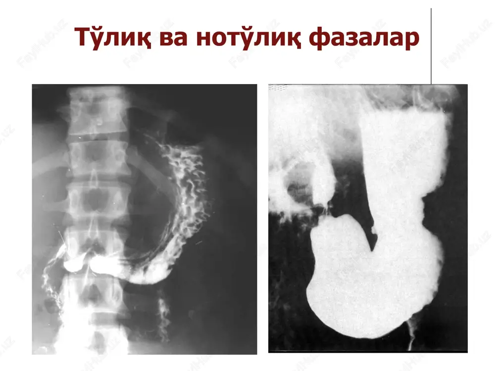 ing torayishi, suprastenotik kengayish, shillik kavat burmalarining ingichkalashishi yoki tekislanishi, usma joylashgan soxada kizilungach devorining kalinlashuvi. ekzofit qizilo'ngach raki endofit qizilo'ngach raki oshqozon kasalliklari: gastritlar privratnik stenozi oshkozon yara kasalligi oshkozon raki gastritlar: 1. yuzaki gastritlar 2. chuqur gastritlar 3. atrofik gastritlar 4. eroziv gastritlar yuzaki gastritlar: areolalari notugri yumalok yoki poligonal shaklli, diametri 2 – 3 mm. chuqur gastritlar: yukori, yumalok yoki oval areolalarining donador tasviri, 2 - 3 dan 5 mmgacha kundalangiga. atrofik gastritlar: oshqozon maydonlarining xar xil shaklli va kattalikdagi dag'al, notekis tasviri – areolalarning kundalang o'lchami 5 mmdan kup. eroziv gastritlar: shilliq qavatda bitta yoki ko'plab eroziyalar bariy sulfatning ozgina mikdori buladi. privratnik stenozi o'sma, yara va kuyishlardan keyin rivojlanadi. rentgenologik belgilari: privratnik kanalining stenozidan keyin oshqozonning diffuz (suprastenotik) kengayishi. och koringa oshqozonda kup suyuklik. oshqozonning shillik kavati keskin va bir tekis kengaygan. oshqozon yara kasalligi morfologik belgilari: «tokcha», tokcha atrofida yalliglanish gardishi va shilliq qavat …