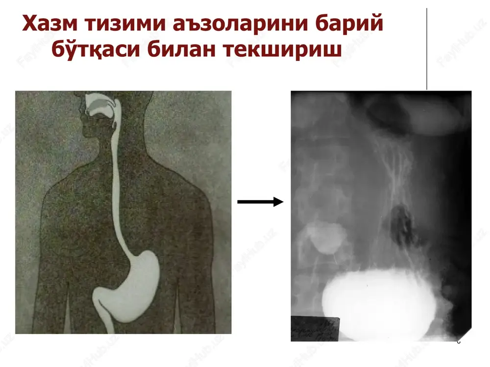 ing buzilishi. ekzofit rak infiltrativ rak yarali rak diffuz rak ingichka va yo'g'on ichak kasalliklari: o'n ikki barmok ichak yara kasalligi yallig'lanish kasalliklari ichak tutilishi ingichka va yo'g'on ichak xavfsiz va xavfli o'smalari girshprung kasalligi dolixokolon megakolon 12-barmokli ichak yarasi oshkozon yarasiga nisbatan 2 - 3 barobar kuprok uchraydi kuprok erkaklarda 95% piezchada, 1 sm dan kichik 85% piezcha deformatsiyalashadi malegnizatsiya yuk belgilari va asoratlari oshkozon yarasidek 12-barmokli ichak yarasi yara kasalligi asoratlari 1. malegnizatsiya 2. qon ketish 3. penetratsiya 4. perforatsiya penetratsiyalanuvchi yara 3ta qavatdan iborat: bariy sulfat, suyuklik, gaz. perforatsiyaning rentgenologik belgilari: diafragma ostida “o'roqsimon yorishish” simptomi aniqlanadi. bo'shliq a'zo perforatsiyasi enterit rentgenologik belgilari: shilliq qavat burmalari yo'qoladi, kontrast modda notekis tarqaladi, ichak devorida xavo va kichik suyuqlik satxi aniqlaniladi. surunkali kolit shikastlangan joyiga qarab turlari: 1. to'liq (pankolit) 2.qisman (transverzit, sigmoidit, proktit). rentgenologik: 1. spastik 2. nospetsifik 3. yarali 4. shilliqli rentgenologik belgilari: yo'g'on ichakning torayishi va …