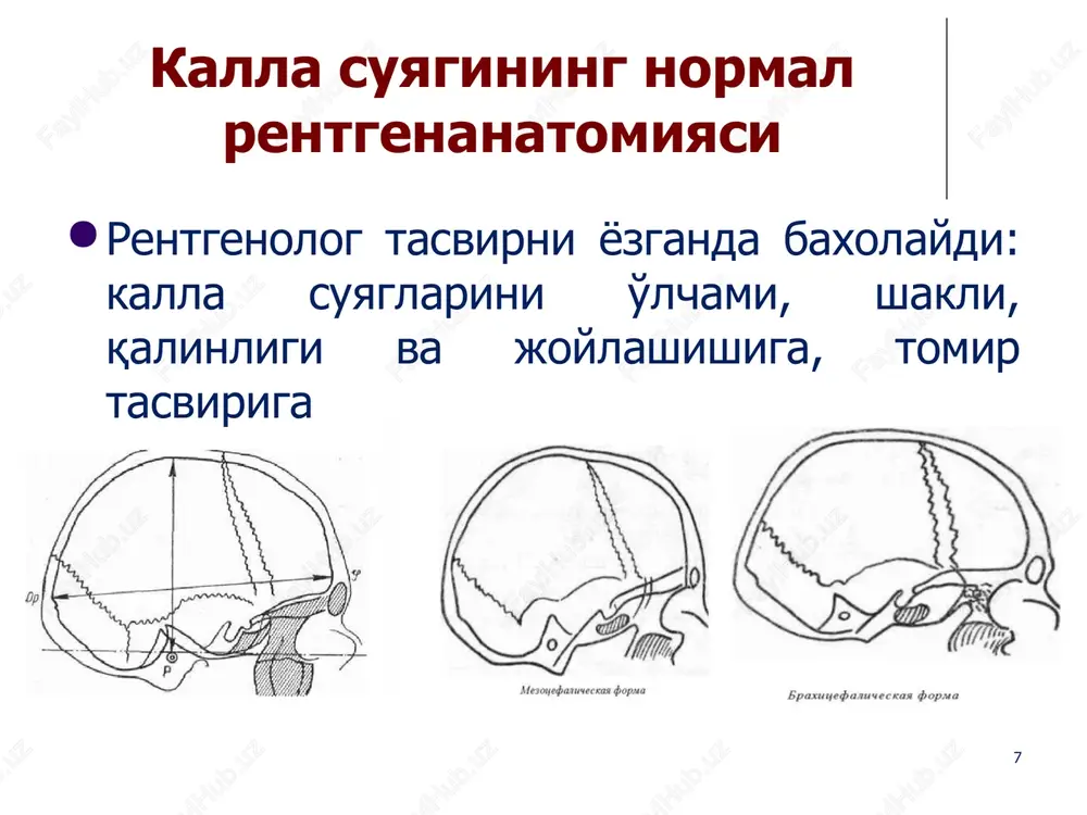 alar va miya suv yuli kengaygan miyaning katta tsisternasi kichraygan iv korincha kengaygan (strelka bilan kursatilgan a tas.) kalla chukurchasining xamma kismini egallagan 1 oylik ‹#› gidrotsefaliyaning ochik gipersekretor shakli exografik: qorinchalarning kengayishi subaroxnaidal bushlik kengayishi yon korinchalar tomir chigalini kengayishi, konturlari deformatsiyalangan, exogenligi oshgan shikastlangan soxada egat exogenligi oshgan 7 oylik ‹#› ochik shakli yarimsharlar va kalla suyagi orasida anexogen soxa kurinmokda egatlarning exogenligi oshgan 3 oylik ‹#› e'tiboringiz uchun raxmat image1.png image2.jpg image3.png image4.png image5.png image6.jpg image7.png image8.png image9.png image10.png image11.jpg image12.png image13.jpg image14.png image15.png image16.png image17.png image18.png image19.png image20.jpg image21.jpg image22.jpg image23.jpg image24.jpg image25.png image26.png image27.png image28.png image29.png image30.jpg image31.png image32.jpg image33.png image34.png image35.jpg image36.jpg image37.jpg image38.jpg image39.jpg image40.jpg image41.png image42.png image43.png image44.png image45.png image46.png image47.jpg image48.jpg image49.jpg image50.png image51.png image52.png image53.png image54.png image55.jpg image56.jpg image57.jpg image58.png image59.png image60.png image61.png image62.jpg image63.jpg image64.jpg image65.jpg image66.jpg image67.jpg image68.jpg image69.jpg image70.png image71.png image72.png image73.jpg image74.png image75.png image76.jpg