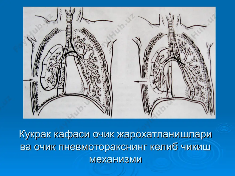 анилади. стандарт шиналар торакоброхиал гипсли бойламлар қўлни танадан узоқлаштирувчи шина елка бўғимида 90 градус бурчак остида бўлиши керак. тирсак бўғими 90-100 гр., елка бўғими 30 гр. гача букилиши елка бўғимининг мушаклари бушашган ҳолат вужудга келади. тушга нисбатан чиккан ички охирнинг турига караб булади. туш олди. туш орти туш усти ташки – акромиал чикишлар ички стериал чикишлар бойлов аппарати зарарланишига караб: тулик нотулик (чала) умров суяги ташки тулик чикишларида а) тулик чикишида-иккала бойлам (умров акромиал, умров, тумшуксимон) шикастланиши кузатилади. б) умров суяги ички тулик чикишларида иккала бойлам (умров ковурга ва умров тўш) шикастланиши кузатилади. умров суяги синишларида фиксация килиш учун кузминский шинасини куйилиши дельбе халкалари умров суяги синишларида олд ва орка куриниши саккизсимон боглам шарашинедзе олд ва орка куриниши қовурғалар синиши барча синишлар ичида 15%ни эгаллайди. қовурғалар синиши классификацияси: локализациясига кўра: паравертебрал аксиляр ўрта ўмров чизиғи бўйича парастернал шикастланишлари бўлиши мумкин: изоляциялашган (1-2 қовурғалар) кўп (3 тадан ортиқ қовурғанинг жароҳатланиши) бир …