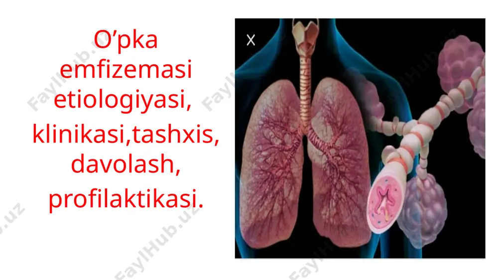 kopincha quticha tovush deyiladi. o`pka ekskursiyasi cheklangan. o`pkaning yuqori chegaralari biroz yuqoriga siljigan pastki chegaralari ikki taraflama pastga siljigan boladi. opkaning tiriklik sig`imi kamayadi. yurak tomir sitemasi tekshirib korilganda yurak tonlari bo`g`iq bo`lib qolganligi taxikardiya borligi aniqlandi yurak chegaralari o`ng tomonga kengaygan bolishi mumkin opka emfizemasi zo`rayib borgan sayin kichik qon aylanish doirasida bosim ortib boraveradi, bu o`ng qorinchaga ortiqcha zo`r kelib, uning gipertrofiyaga olib keladi. keyinchalik yurakning shu qorinchasida yetishmovchilik paydo bolib, u jigarning kattalashib ketishi va badanga shish kelishi bilan birga davom etadi. dekompensatsiyalangan o’pka yuragi rivojlangan bemorlarga yurak glikazidlari, siydik haydovchi dorilar, miokarda metabalizmni yaxshilovchi dorilar buyiriladi.nafas yetishmovchiligi rivojlanganda nafas olish gimnastikasining 4-6xaftali kurslari o’tkaziladi. bunday davolash o’pka ventelatsiyasini yaxshilaydi.rivojlangan o’pka yetishmovchiligi mavjud bemorlarga xajmi, soni, bosimi, boshqariladigan xar hil turdagi respiratorlarda o’pkaning suniy ventelatsiyasi o’tkaziladi. auskultatsiyada susaygan vezikuyar nafas boladi. bunga alveolalar aro tosiqchalarning yoqala borishi va nafas chiqarganda so`nmaydigan va o`pkada qoldiq havo hajmi ko`payishiga …