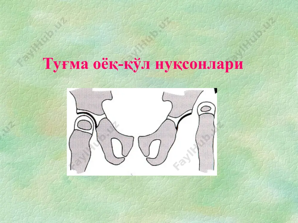 нда туғма чиқиш кам ҳолларда учрайди. агар «бурчакларга» жавобгар ген қўшилса, туғма сон суяги чиқиш олди ҳолати юзага келади. уччала геннинг биргаликдаги таъсири туғма сон чиқишига олиб келади. чаноқ-сон бўғими туғма дисплазияси этиологияси тератогенез теорияси ҳомила давридаги турли факторлар таъсирида оёқ-қўл аномалиялари ҳомиладорлиниг 4-6 ҳафталарида тератоген факторлар таъсирида юзага келаи. аномалия юзага келиши учун унинг шаклидан кўра давомийлиги муҳимроқдир. тератогенлар кимёвий : «талидомид», алкоголь, никотин инфекцион: токсоплазмоз, цитомегаловирус, герпес, сифилис, рубелла физик: радиация чаноқ-сон бўғими туғма дисплазияси патогенези сон суяги бошчаси аддукторлар томонидан юқори ва ташқарига силжиб, текисланади. суякланиш ядролари кеч пайдо бўлиши кузатилади. ацетабулум текисланади ва фиброз-ёғ тўқима билан тўлади. ацетабулум лаби қалинлашади ва сон суяги бошчаси қайта жойига солинишини блоклайди. кенгайган капсула, кичик ацетабулум ва сон суяги проксимал қисми бурчаклари ўзгарганлиги – асосий мойиллик омилларидир. чаноқ-сон бўғими туғма дисплазияси патогенези соннинг юмалоқ бойлами узунлашади ва гипертрофияланади. капсула чўзилади чаноқ-сон бўғими мушаклари қисқаради, калталанади ва сон суяги бошчасини блоклайди. …