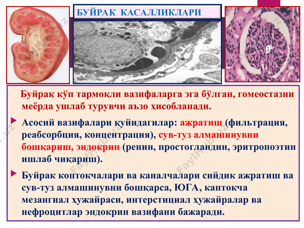 нли 3. каналчада оқсил модда 1 2 3 сурункали гломерулонефрит сурункали гломерул-рит. 12 ойдан узоқ, яширин ва рецидивланиб кечиш хос. сабаби номалум, механизми – иммун бирикма реакция. морфология 2 типи фарқ қилинади: мезангиал ва склерозланган. мезангиал гломерулонефрит: икки турда учрайди: 1) мембрано-пролифератив (мезангиокапилляр), 2) мезангиопролифератив. морфологик жиҳатдан буйрак каптокчалари йирик, мезангиоцит-лар пролиферацияланиб кўп ҳужайрали, гбм қалинлашган, унда иммун депозитларнинг интерпозицияси, иккига ажралиши, “темир йўлсимон” базал мембрана. каптокчаларда бўлакчалар пайдо бўлиб, лобуляр гломерулонефрит юзага чиқади. каптокчалар ўзгаришлардан ташқари, каналчалар эпителийсида дистрофия ва атрофия, стромада интерстициал лимфогистиоцитар инфильтрация ва склероз ривожланади. оқибатда буйрак иккиламчи бужмайишга учрайди. диффуз склерозланган гломерулонефрит. бу гломерулонефритнинг барча турлари якунловчи даври ҳисобланади. ёруғлик микроскоп остида буйрак тўқимасида склероз, гиалиноз, каптокчалар ва каналлар атрофияси аниқланади. макро – буйраклар кескин кичиклашган, каттиқлашган, юзаси майда донадор тусга кирган ва “иккиламчи бужмайган буйрак” дейилади. сурункали гломерулонефрит электрон микроскопияда базал мембранада (1) осмиофил депозитлар мезангиопролифератив гломерулонефрит «иккиламчи бужмайган буйрак» липоид нефроз – «минимал …