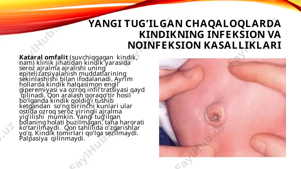 acha ko‘tariladi. qon tahlilida leykotsitoz chapga siljish bilan,echt oshishi. kindik yarasi kindik yarasi – kindik pioreyasi yoki omfalit asorati sifatida paydo bo‘lish mumkin kindik yarasining tubi odatda seroz-yiringli yoki yiringli ajralma bilan yopilgan bo‘ladi. uni olib tashlangandan so‘ng yaralanish aniqlanadi. kindik yarasiga ishlov berilayotganida kindik yarasining tubini bekitib turgan qoraqo‘tir olib tashlanmasa, yara rivojlanish ehtimoli katta bo‘ladi. bemorning umumiy holati kasallikning birinchi kunlarida buzilmagan bo‘lish mumkin,keyinchalik intoksikatsiya belgilari qo‘shiladi. kindik tomirlari kasalliklari. davolash – diagnostika maqsadida kindik tomirlari kateterizatsiya qilingan yangi tug‘ilgan chaqaloqlar katta xavf guruhiga kiradilar. kindik tizimchasi gangrenasi (kindik qoldig‘i). tug‘ilishiga yordam berish muassasalarida tug‘ilgan bolalarda amalda uchramaydi. kasallik hayotining dastlabki kunlarida bo‘ladi va uni anaerob tayoqcha chaqiradi. kindik qoldig‘ining mumifikatsiyasi to‘xtaydi. u nam bo‘lib qoladi, qo‘ng‘ir tusga kiradi va undan yoqimsiz chirindi hid keladi. kindik qoldig‘ining tushib ketishi kechikadi. kindik yarasida birdaniga yiringli ajralma paydo bo‘ladi. bemorning umumiy ahvol o‘zgargan, harorati ko‘tariladi, intoksikatsiya belgilari kuzatiladi, qon tahlilida …