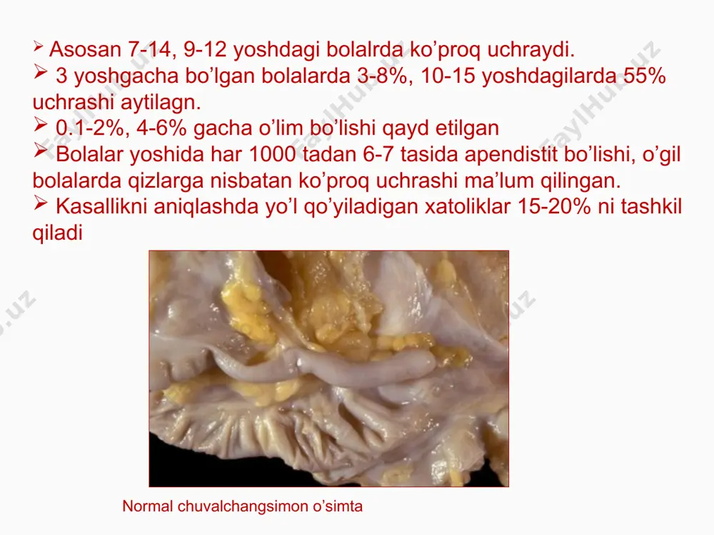 bo’lagidagi ximoya (passiv) taranglashuvi qorin parda ta’sirlanishi (shetkin-blyumberg simptomi) o’tkirt apendistit kasalligida aniqlanadigan simptomlar. ўткир аппендицитни локал симптомлари воскресенский («кўйлак») – кўйлак устидан сирпанувчи ҳаракат қилганда ўнг ёнбош соҳада оғриқни кучайиши ровзинг – чап ёнбош соҳада перкуссия қилганда ўнг ёнбош соҳада оғриқнинг кучайиши раздольский – ўнг ёнбош соҳани перкуссиясида шу соҳада оғриқ бўлиши ситковский – чалқанча ётган ҳолатдан чап ёнбошга бурилаганда, ўнг ёнбош соҳада оғриқни кучайиши бартомье-михельсон – бемор чап ёнбошда ётганда, ўнг ёнбош соҳани пальпацияси оғриққа олиб келади кохер-волкович – оғриқни эпигастрийдан ўнг ёнбош соҳага кўчиши ўткир аппендицитни умумий симптомлари оғиз қуриши ва тилни оқ караш билан қопланиши тахикардия субфебрил температура эчт ошиши лейкоцитоз лейкофорулани чапга силжиши билан differensial diagnostikasi eiringli otit, tanzilit, o’bd, plevrapnevmoniya , gijja invaziyasi xolesistopatiya, pankreatit, infeksion gepatit, dizenteriya, revmatizm, buyrak sanchig`i, siedik tosh kasalligi, gemolitik pur-pura va boshqalar. qo’shimcha instrumental tekshirish usullari elektrotermometriya utt teplovidenie elektromiografiya laparoskopiya kt, mrt қорин бўшлиғини ультратовушли текшируви чувалчангсимон …