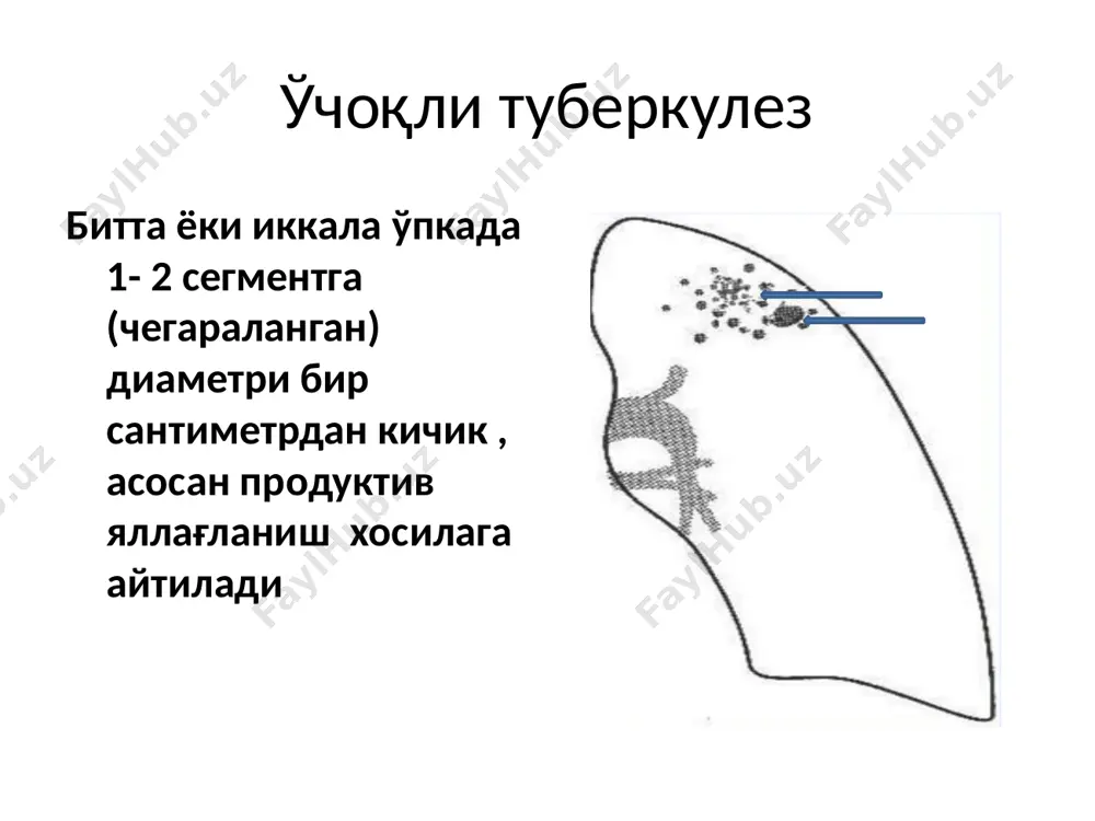 ача) локализация бўйича: юқори сегментларда (s 1. 2) ва пастки бўлагини(s 6) сегментида юмшоқ ўчоқли туберкулез чап ўпкани юқори бўлагида ўмров остида бир нечта йирик, чегарали ноаниқ, интенсивлиги ўрта юмшоқ ўчоқли туберкулез (абрикосов ўчоқли) ашофф – пуль ўчоқлари ўчоқли туберкулезни кечиш хусусияти: клиник белгилари суст ёки умумман бўлмайди, шу сабабли аксарият беморлар флюорография текширувда аниқланади. беморларни учдан бирида интоксикация синдроми ва нафас йўлларини зарарланиш синдроми суст ривожланади интоксикация белгилари: субфебрил иситма кечқурунлари, тана қизиши, ўқтин- ўқтин жунжикиш, кўп терлаш, холсизлик, иштаха пасайиши, уйқу бузилиши. баъзи холларда ўчоқли туберкулез кечиши гипертиреозга ўхшаб кетади: қалқонсимон безни катталашуви, тахикардия, кўзлар йилтирайди, тана вазни ўзгариши, кўзғатувчанлик кўкрак қафасида , кўраклар аро майдонда , елкаларда оғриқ. йўтал доимий эмас, аксарият қуруқ, баъзида оз миқдорда балғам билан. кам холларда қон туфлаш кузатилиши мумкин . ўчоқли туберкулезни аниқлаш йўллари: флюорографик текширувда шифокорга мурожаат қилганда контакт шахсларни текширув жараёнида диагностика: умумумий қон анализида: аксарият холларда ўзгаришлар аниқланмайди, айрим …