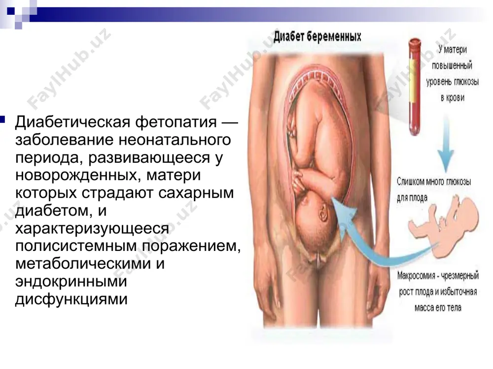 их сроках (у 30% беременных, что в 4 раза чаще, чем в общей популяции); тяжелые гестозы, которые отмечаются почти у 50% беременных с сахарным диабетом (в общей популяции — 3-5%); артериальная гипертензия, индуцированная беременностью, и, следовательно, повышение риска преэклампсии и эклампсии (в 4 раза чаще, чем в популяции); многоводие; фетоплацентарная недостаточность и хроническая внутриутробная гипоксия плода; почечные инфекции и вульвовагиниты на фоне снижения неспецифической резистентности организма; риск во время родов в связи с крупным плодом; повышенный риск оперативных вмешательств (кесарево сечение), операционные и послеоперационные осложнения; высокий риск преждевременных родов (отмечаются в 24% наблюдений по сравнению с 6% в популяции); пороки развития плода и мертворождаемость (в 10 — 12%). при беременности на фоне сахарного диабета в 90-100% наблюдений у плода формируется синдром, называемый диабетической фетопатией. перинатальная смертность при диабетической фетопатии в 2-5 раз выше, чем в общей популяции. в основе деабетической фетопатии лежат несколько факторов: фетоплацентарная недостаточность, гормональная плацентарная дисфункция, гипер-гликемия …