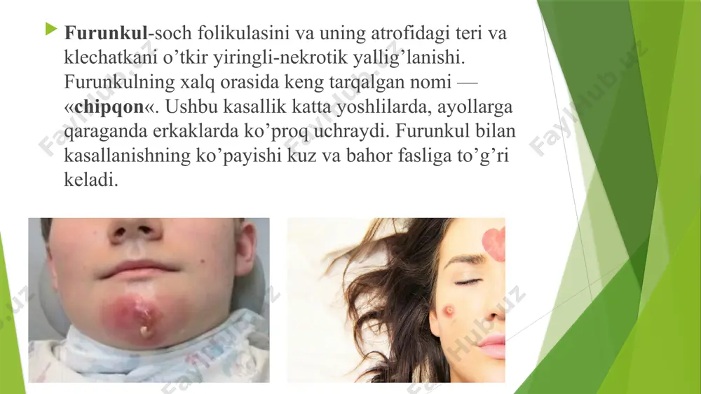 iga u sezilarli qizil-ko’k rangda bo’ladi, so’ng asta-sekin rangsizlanib, deyarli ko’rinmas holga keladi. tashxis: umumiy qon va siydik tahlillari; qonda qand miqdorini aniqlash uchun tahlil; siydikni bakteriologik ekish; faringo- va rinoskopiya; burun yon sinuslarning rentgenografiyasi; flyuorografiya; qorin bo’shlig’i a’zolari va buyraklarning ultratovush tekshiruvi. zarur bo’lganda, bemorga qo’shimcha ravishda endokrinolog, gastroenterolog, pulmonolog, otorinolaringolog va boshqa mutaxassislar maslahat beradi. differensial diagnostikasi davolash: furunkul yetilishi bosqichida unga ixtiolli bog’lamlar qo’yiladi, quruq issiq, uych-terapiya qo’llaniladi. u ochilganidan so’ng, gipertonik natriy xlorid eritmasi, metiluratsil bilan kombinatsiyalangan xloramfenikol saqlagan malham bilan turunda qo’llaniladi. nekrotik o’zakning chiqishi qiyin bo’lsa, proteolitik fermentlar ko’rsatiladi: tripsin, ximotripsin. tuzalish bosqichida davolanish antibakterial va shifobaxsh vositalar bilan amalga oshiriladi davolash yallig'lanish sohasi 70 0+2% salitsil spirt bilan artilib nacl gipertonik eritmasi bilan bog'lam qo'yiladi va tomchilab doimiy ho'llab turiladi. teriga tashqaridan har qanday ta’sir etish, teginish taqiqlanadi (ayniqsa-soqol olish, timdalash, siqish}. yiringli jarayon atrofidagi to'qimalarga anestetiklar novokain, lidokain, trimekain (eritilgan antibiotikli) bilan …