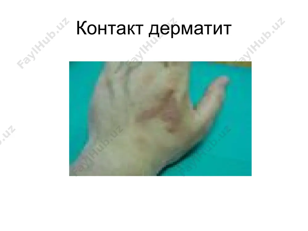 з қаватнинг бўкиши, дермада лимфоцит, эозинофиллар нейтрофиллардан иборат инфильтрация кузатилади. токсидермияларда терида бўладиган ўзгаришлар қаварчиқ-кўп миқдордаги уртикар тошмаларнинг тошиши доғли-папулёз тошмаларнинг кузатилиши дориларнинг фиксацияланган доғлари лихенификация кўринишида эритемалар пурпуралар; қон қуйилишлар пуфак ва пуфакчалар. пенициллин билан даволанган беморда квинке шиши ампициллин билан даволанган беморда тошмалар нифедепин билан даволанган беморнинг оёқларида шиш фенитион чақирган аллергик тошма фенолфталеин қабул қилгандан кейинги фиксацияланган токсидермия тетрациклин қабулидан кейинги фиксацияланган токсидермия фенилбутазондан кейинги фиксацияланган токсидермия стивенс-джонсон синдроми лаелла синдроми лаелла синдроми амиодарон қабулидан кейинги дисхромия моноциклиндан кейинги дисхромия варфаринли некроз гепариндан кейинги некроз пишган тери синдроми хайз даврида ишлатилган тампон натижасида келиб чиқган токсик шок ва тери ўзгаришлари медикаментоз токсикодермия токсикодермия токсидермия токсикодермия сульфаниламидли эритема экземанинг эритематоз босқичи медикаментоз токсикодермия. эритематоз-сквамоз шакли. себореяли дерматит даволаш усуллари этиологик факторнинг таъсирини тўхтатиш таъсир қилаётган моддани организмдан тезроқ чиқариш. гипоаллерген диета қўллаш умумий даво усуллари энтеросорбентларни қўллаш антигистамин препаратларни қўллаш гипосенсибилизацияловчи препаратлар дезинтоксикацион препаратлар оғир ҳолларда глюкокортикостероид гармонларни …
