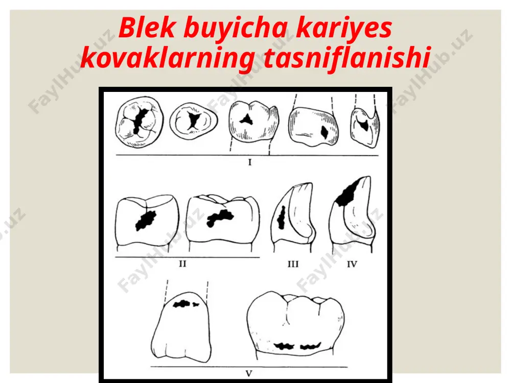 ii sinf karioz bushliqlarini charxlash va plombalash - Page 4