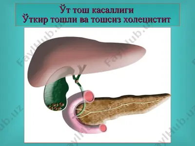 ўт тош касаллиги — PPT