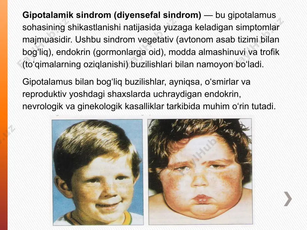 i erta boshlanishi. metabolik (modda almashinuvi) gs og‘irlik o‘zgarishi (semizlik yoki ortiqcha vazn), diabetga moyillik, lipid almashinuvi buzilishi. aralash (kombinatsiyalangan) gs yuqoridagi belgilarning bir necha turi bir vaqtda mavjud bo‘ladi. 3. davr bo‘yicha klassifikatsiya bolalik davridagi gs gipotalamik buzilishlar bolalikda boshlanadi. pubertat (o‘smirlik) davridagi gs (gspp) o‘smirlikda rivojlanadi va jinsiy yetilish bilan bog‘liq buzilishlar mavjud. kattalar davridagi gs kattalar yoshida paydo bo‘lgan gipotalamik buzilishlar 4. kelib chiqish asosida tug‘ma gs genetik yoki homila davrida yuzaga kelgan gipotalamus buzilishlari. olingan (akviy) gs hayot davomida qozonilgan sabablar natijasida yuzaga keladi (jarohatlar, infeksiyalar, stress). 🧬 gipotalamik sindromning patogenezi (rivojlanish mexanizmi) boshlang‘ich zararlovchi omillar (stress, infeksiya, bosh miya shikastlanishi, tug‘ma yetishmovchilik) ↓ gipotalamus faoliyatining buzilishi relizing-gormonlar (kortikoliberin, gonadoliberin) sekretsiyasi izdan chiqadi 3 neyromediator muvozanatining buzilishi endorfinlar ko‘payadi dofamin kamayadi katexolaminlar (adrenalin, noradrenalin) va serotonin ortadi ↓ bu moddalar gipotalamus yadrolarini haddan tashqari qo‘zg‘atadi ↓ endokrin va vegetativ tizimlar faoliyati buziladi gormonlar (gonadotropinlar, tsh, acth) …