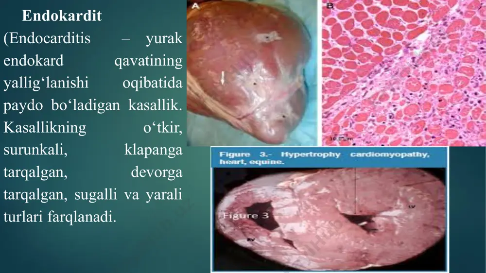iyasi, endoarterit, yuraknuqsonlariyokihayvonningto‘satdano‘libqolishibilantugallanishimumkin. ko‘p hollarda yallig‘lanish jarayonlari miokard va perikardga ham tarqaladi (pankardit . surunkali hollarda yallig‘langan joylarga biriktiruvchi to‘qimaning o‘sishi natijasida orttirilgan nuqsonlar kelib chiqadi. qonning toraygan teshiklar orqali o‘tishidan stenotik shovqinlar ya’ni sistolik yoki diastolik endokardial shovqinlar hosil bo‘ladi. belgilari.kasallangan otda holsizlanish, yarali endokarditda esa soporoz holat kuzatiladi. ishtahaning yo‘qolishi, oriqlash, tana haroratining ko‘tarilishi (qaytalovchi isitma va yurak-qon tomir yetishmovchiliklariga xos belgilar kuzatiladi. puls avvaliga katta, to‘lishgan yoki o‘rtacha to‘lishgan, keyinchalik esa kichik va sust to‘lishgan bo‘ladi. o‘tkir endokarditda yurak turtkisi kuchaygan bo‘ladi. yurak tonlari, asosan birinchi ton avvaliga kuchayadi, keyinchalik, susayadi yoki mutlaqo eshitilmasligi ham mumkin. yurak tonlari asosan endokardial shovqinlar bilan qo‘shilib eshitiladi. yarali endokarditga xos belgilardan biri – kasallikning kechishidagi nisbatan qisqa vaqt mobaynida endokardial shovqinlar jadalligi va xarakterining o‘zgarib turishi hisoblanadi. sugalli endokarditda endokardial shovqinlar nisbatan doimiy xarakterda bo‘ladi. qon aylanishining buzilishi o‘pka, jigar, buyraklar va hazm a’zolari ishining buzilishiga olib keladi. yarali endokardit …