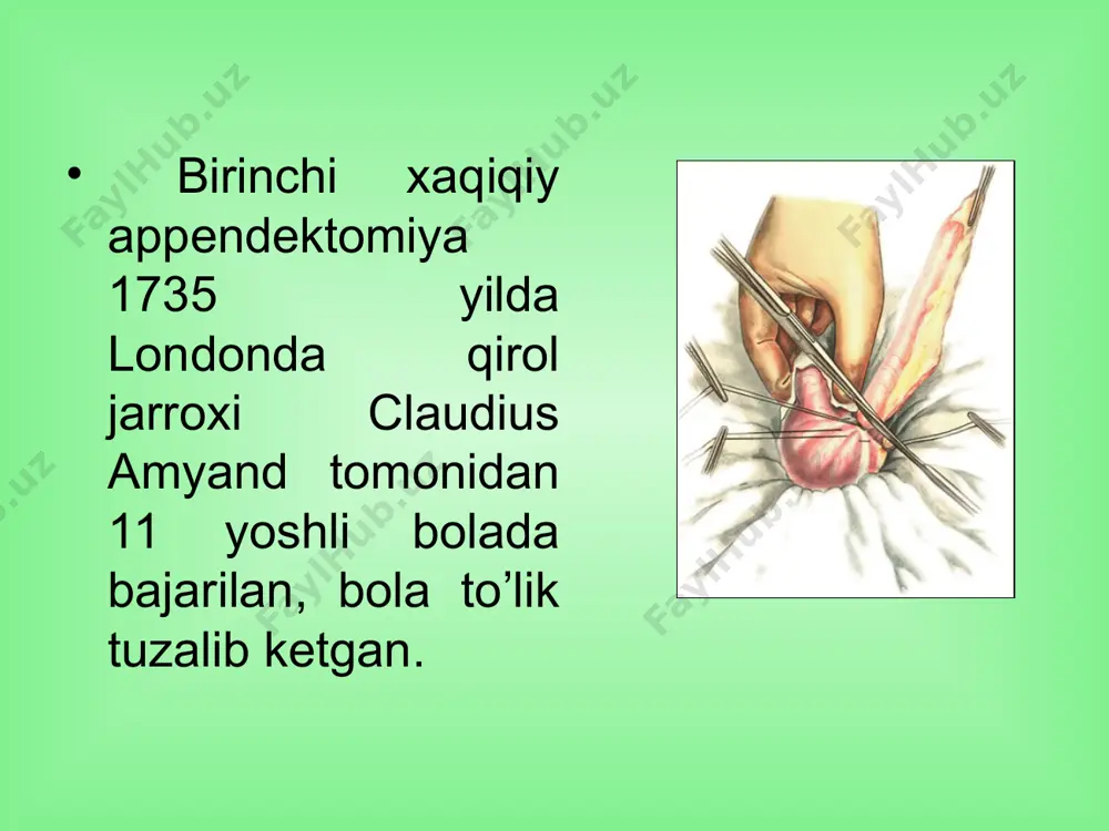 asi (allergiya yoki gijja invaziyasi) reflektor yo‘l (me'da, jigar, ichaklar kasalliklari) nerv tolalarini bevosita ta'sirlanishi (chuvalchangsimon o‘simtada yot jism, najas toshlar, buralishlar) chuvalchangsimon o‘simta mushak va qon tomirlarini spazmi chuvalchangsimon o‘simtani devorini shishi chuvalchangsimon o‘simtani kirish teshigini yopilishi o‘tkir appenditsit xastaligini v.i. kolesov bo‘yicha klassifikatsiyasi (tasnifi) appendikulyar sanchiq (kolika). oddiy appenditsit. destruktiv appenditsit: flegmonoz, gangrenoz, perforativ appenditsit. asoratlangan appenditsit: appendikulyar infiltrat, appendikulyar abssess, peritonit, pileflebit va boshqalar. chuvalchangsimon o‘simtaning odatdagi ko‘rinishi o‘tkir oddiy appenditsit o‘tkir appenditsitning destruktiv turlari chuvalchangsimon o‘simta empiemasi gangrenoz perforativ appenditsit shikoyatlari ko‘p uchraydigan 1 – o‘ng yonbosh sohadagi og‘riq 1. og‘riq epigastral sohadan boshlanib keyin-chalik o‘ng yonbosh sohaga ko‘chadi (koxer-volkovich simptomi) 2. doimiy (kamdan-kam to‘lg‘oqsimon), 3. kuchsiz (ezuvchi) 4. hyech qaerga tarqamaydi 2 – ko‘ngil aynish, qayt qilish (1 yoki 2 marotaba) 3– kam quvvatlik, ishtahaning susayishi tenezmlar – chanoq sohasida joylash-ganda, ich ketish – medial joylashganda, dizuriya – retrotsekal joylashganda, og‘iz qurishi, qorinning dam bo‘lishi …