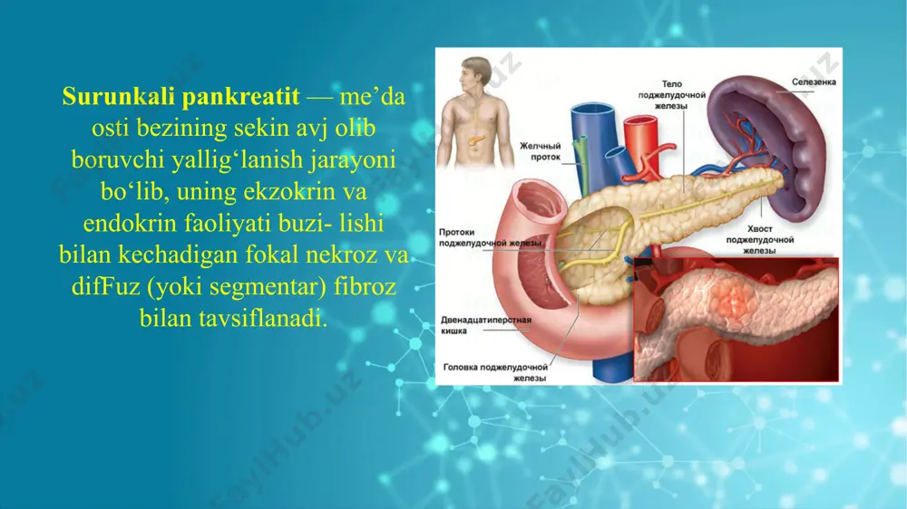 kning faqat 60—80%da etio- logiyasi aniqlanadi, qolgan holatlarda kasallik noma’lum etiologiyali deb ataladi. patogenez. surunkali pankreatitda asosiy patogenetik mexanizm bo‘lib, o‘z fermentlar (tripsinogen, xemotripsinogen, proelastaza, fosfolipaza a) faolligining oshishi natijasida bez to'qimasining zararlanishi (slush, koagulyatsion nekroz, bez to‘qimasining fibrozi) hisoblanadi. atsinar hujayralaming o‘limi va me’da osti bezi sekretor yol lining obstruksiyasi natijasida 12 b.i. pankreatik fermentlar ajralishi susayadi. natijada, me’da osti bezining tashqi sekretor yetishmovchiligi kelib chiqadi. langerxans orolchasining zararlanishi natijasida uning endokrin fao- liyati buziladi: glyukagon yetishmasligi (gipoglikemik sindrom) va insu­lin yetishmasligi (qandli diabet) kelib chiqadi. yevropa mamlakatlarida qabul qilingan (marsel—rim, 1988) tasnif- ga ko‘ra quyidagi klinik shakllari farqlanadi: surunkali kalsifikatsiyalangan pankreatit — kasallikning ko‘p uchraydigan shakli bo‘lib, ko‘proq alkogol etiologiyali bo‘ladi. me’da osti bezi- ning notekis zararlanishi va kalsifikatsiyasi, bez yollarida toshlar hosil bolishi va stenozlanishi, atrofik jarayonlar rivojlanishi bilan tavsiflanadi. surunkali obstruktiv pankreatit — me'da osti bezining asosiy naychasi (yoli)ning o‘sma, striktura, papillyar stenozi hisobiga obstruksiyasi natijasida …