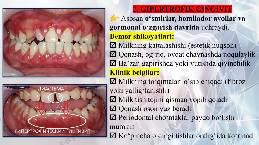 h + antiseptik + gel + vitamin + gigiena. 1. yengil darajadagi parodontit bemor shikoyatlari: tish yuvganda yoki qattiq ovqat chaynaganda milkdan qon kelishi. milkda noqulaylik va yengil achishish. og‘izdan yoqimsiz hid kelishi. klinik belgilar: milk yengil shishgan va qizarib turadi. periodontal cho‘ntaklar chuqurligi 3.5 mm. tishlarda ozgina blyashka va tosh mavjud. milk yengil bosilganda qon keladi. tishlar siljimagan, suyak rezorbsiyasi minimal (rengenogrammada 1/3 gacha). yengil darajadagi parodontitda davolash bosqichlari: professional gigiena – tish toshi va blyashkani olib tashlash. antiseptik chayish – xlorheksidin, dorivor o‘simlik damlamalari. mahalliy gel – metrogil-denta, holisal, vitaminoterapiya – c, b, a, e vitaminlari. fizioterapiya – milk massaji, lazer. profilaktika – gigiena nazorati, muntazam ko‘rik. 👉 asosiysi: tozalash + antiseptik + gel + vitamin + fizioterapiya + gigiena. 15 2. o‘rta darajadagi parodontit bemor shikoyatlari: doimiy qonash, hatto yumshoq ovqatda ham. milkda og‘riq va sezuvchanlik, chaynashda noqulaylik. og‘izdan yomon hid kuchaygan. ba’zan tishlarning siljishi yoki orasining …