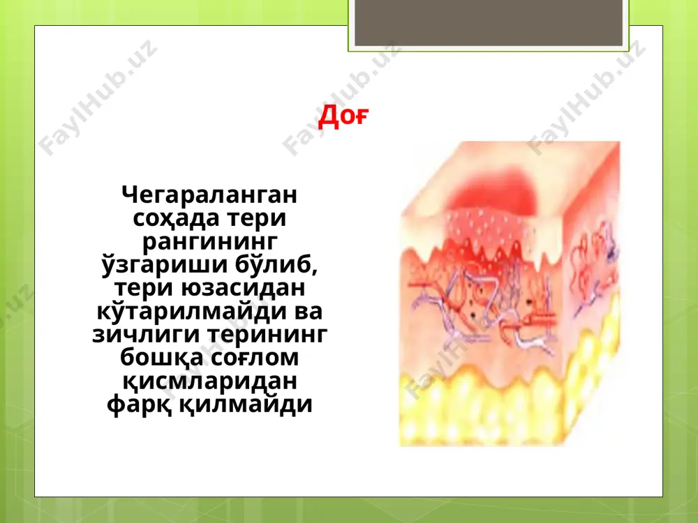 'la, atrofi giperemiyali halqa bilan chegaralangan morfologik element. bo'shliq epidermis hujayralarining o'limi natijasida paydo bo'ladi. joylashuv joyiga qarab yuzaki va chuqur yiringchalar farqlanadi. sistemali qizil yugurukda yuzdagi “kapalak” shaklidagi eritematoz toshma yuvenil dermatomiozitda yuzdagi eritema tangacha epidermisning shox qavatidan ajralib tushishidan hosil bo'lgan plastinka. tangachaning rangi sariq yoki kulrang rangda bo'ladi. o'lchamiga ko'ra tangachalar bargsimon (5 mm dan katta), plastinkasimon 1-5 mm), va qipiqsimon (1 mm dan kichik) bo'lishi mumkin po'stloq terida pufakchalar, pustulalar va suvchirab turgan yuzalarning ekssudatining qurib qolishi natijasida paydo bo'luvchi element. po'stloqlar seroz (tiniq seroz ), yiringli (sariq) va qonli (to'q jigarrangda) bo'ladi. ekssudativ kataral diatezli bolalar yuzidagi po'stloqchalar qatqaloqlar deyiladi (5-20 rasm eroziya epidermis chegarasidagi terining yuza defekti. eroziyalar pufaklarning, pusutulalarning yorilishi natijasida paydo bo'ladi; terining ishqalanishi yoki matseratsiyasi natijasida ham hosil bo'lishi mumkin. eroziyalar terida o'zgarish qoldirmasdan tuzaladi. yara terining chuqur defekti bo'lib, epidermis, derma va ba'zan teri ostidagi boshqa to'qimalarning zararlanishi bilan kechadi. …