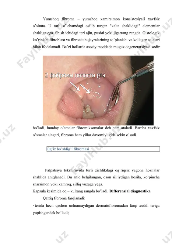 di. qayta o’sishga moyilligi tufayli o’simta kesmasi teri osti yog’ to’qimasi bilan birgalikda amalga oshiriladi, klinik jihatdan aniqlangan o’simta chegaralaridan 1,5—2 sm orqaga chekinadi. katta nuqsonlar bo’lsa, nuqsonni plastik almashtirishning maqsadga muvofiq variantlari tavsiya yetiladi. lipoma yeng keng tarqalgan xavfsiz shishdir. u inson tanasining istalgan joyida, shu jumladan ichki a’zolarning shikastlanishi holatlarida joylashishi mumkin. u bir necha klinik shakllarda namoyon bo’ladi. lipoma o’sish shakliga ko’ra farqlanadi: 1) teri osti shakli — har doim xavfsiz va teri osti to’qimasida joylashgan; 2) intermuskular-malignizatsiyalanishga moyil va tabiatiga ko’ra xavfli o’smalarga yaqin turadi. klinikasi. teri osti lipomasi yumshoq, og’riqsiz hosila, harakatchan, teri bilan bog’lanmagan, yumshoq elastik konsistensiyali. stromaning rivojlanganligiga qarab zichroq bo’lishi mumkin. lipoma zich qobiq bilan o’ralgan bo’lib, undan tolalar bo’shliqqa chuqur kirib, lipomaga bo’lakli tuzilish beradi. ikkinchi tur o’simta palpatsiya paytida zichroq bo’ladi, u ba’zan fibrolipoma deb ataladi. lipoma ustidagi terining rangi odatda o’zgarmaydi. shishning kattaligi 1 dan 10 sm gacha o’zgarib …