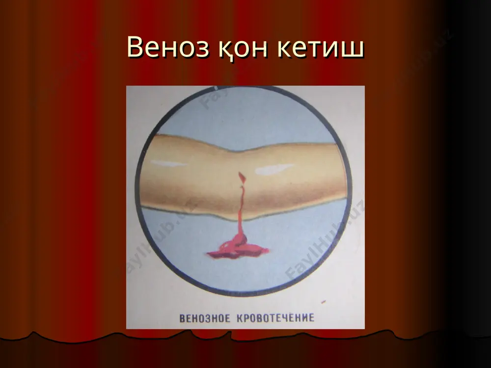 ни махаллий қўллаш: а. тромбин б. гемостатик губка в. фибрин губкаси г. фибрин пардаси д. қуруқ плазма е. биологик антисептик тампон.