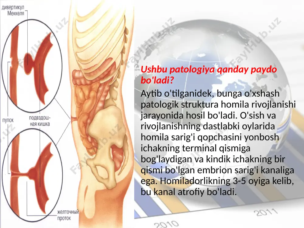 ertikulit) kataral, flegmonoz, gangrenoz (perforatsiyali yoki perforatsiyasiz) bo'lishi mumkin. bunda qorinda og'riq, ko'ngil aynishi,tana haroratining ko'tarilishi,et junjikishi, peritoneal simptomlar bo'lishi kuzatiladi. obyektiv tekshirganda — mushak tarangligi va o'tkir appenditsitga xos boshqa belgilar kuzatiladi. diagnostik xatolarga ko'pincha shu sababli yo'l qo'yiladi. divertikul shilliq pardasining yarasi, yallig'ianish natijasi sifatida yoki me’da shilliq pardasining ektopiriangan sohasi ajratadigan xlorid kislotasining ta ’siri ostida paydo bo'ladi. klinik belgilari — o 'rtacha og'riqlar, aksariyat qon ketish, hatto profuz qon ketish bilan kuzatiladi. divertikul perforatsiyasi (yallig'ianish, yara, gangrena, axlat yoki o't suyuqligi toshidan yoki yot jismdan yotoq yara natijasi) sababli amalda hech qachon operatsiyaga qadar aniqlanmaydigan peritonit bilan o'tadi. mekkel divertikulida operatsiya patologiyaning rivojlanishini bartaraf etuvchi terapevtik usullar jarrohlik aralashuvdan iborat bo'lib, uning yo'nalishi va metodologiyasi ushbu patologiyaning qanday aniqlanganiga bog'liq –ya’ni alomatlarga qarabmi yoki operatsiya davomida. agar semptomlar bo'lmasa va kasallik to'g'ridan-to'g'ri operatsiya stoliga tashxis qo'yilgan bo'lsa, jarrohlar darhol ko'ndalang choklar yordamida divertikulani olib tashlashni boshlaydilar. …