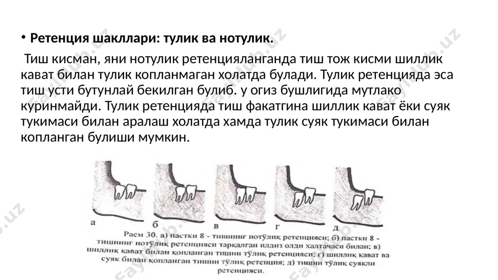 бга олит керак. олиш техникаси юкориги кесувчи хамда козик тишларни олиш усули каби кетма-кетликда амалга оширилади. юкори жаг бушлигининг бутунлигига зарар етганда, жарохат урнини ювмасдан , перфорацион тешикни ёпиш оркали окори жаг бушлиги беркитилади. кушни тиш илдиз кисмининг очилиб колиши холларида, тиш нерв толалари ва кон томирларининг зарарланиши илдиз учи резекциясини утказишни талаб этади. тулик ва нотулик ретенцияланган учинчи катта озик тишларини олишда альвеоляр усикни коплаб турувчи шиллик кават тугри бурчак остида кесилади. шиллик кават-суяк усти пардали лахтак ажратилиб. омбур ёки элеватор ёрдамида тишлар олинади. шиллик каватта чок куйиб, жарохат тикилади. нотулик ва тулик ретенцияланган пастки жардаги тишлар, уларнинг жойлашган урни, нерв каналига ва кушни тишларга нисбатан кандай жойлашганлигини аниклагандан сунг олинади. пастки жагнингальвеоляр усик сохасида жойлашган тишларни олишда купинча трапециясимон ёки ярим овалсимон кесув утказилади. бунда шиллик каватли лактак ахратилиб. дахан ости ёригидан чикувчи дахан ости нерви ва шу номли кон томирларни хисобга олган холатда тиш олинади. пастки жагнинг …