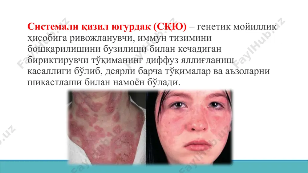 nish va shikastlanish chaqiradi; bir vaqtning o'zida lizosomal o'tkazuvchanlik oshib, yallig'lanish mediatorlari hosil bo'lishi va kinin tizimi faolligini oshishi kuzatiladi; turtki bo'luvchi omillar: dori, vaktsina va qon zardoblarni qabul qila olmaslik, fotosensibilizatsiya, ultratovush nurlanishi, xomiladorlik, tug'ish, abortlar. sqyu klinikasi kasallikning eng cho'qqi namoyon bo'lishi 14-40 yoshni tashkil etadi. boshlang'ich belgilari: xolsizlik, ozib ketish, tana xaroratini kutarilishi teri va shilliq qavatni shikastlanish belgilari faqat 10-15% bemorlarda teri o'zgarishlari bo'lmasligi mumkin. dubois (1976) ta'kidlashicha, teri shikastlanishini 28 shakli mavjud. ularning eng ahamiyatlisi: izolirlangan va qushilib ketgan eritematoz dog'lar – shakli turlicha, biroz shishgan bo'lib, sog'lom teridan ajralib turadi; ko'pincha yuz, bo'yin, ko'krak, tirsak va boldir-panja bo'g'imlari atrofida kuzatiladi; ushbu dog'larning eng ko'p diagnostik ahamiyatlisi kapalak shakli (burun va lunjlarda joylashgan eritrematoz dog'lar); eritrematoz dog'lar alvon qizil rangda bo'ladi (xuddi kuyoshda kuygandek); sqyu surunkali kechganda eritrematoz dog'lar infiltratsiyalangan, giperkeratoz, qipiqlanish va terini chandiqli atrofiyalanishi bo'ladi; lyupus-xeylit – sariq qipiklar, erroziyalar va atrofiya uchastkalari …