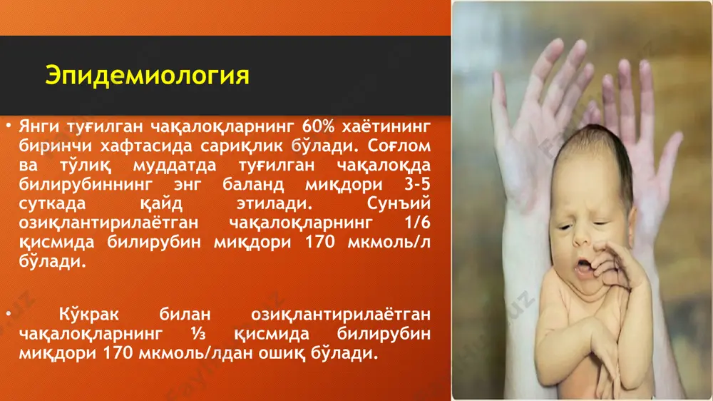 некрозгача олиб борадиган дегенератив ўзгаришлар чақирувчи тўқима захридир. бевосита билирубин жигар хужайраларидан ўт қопи капиллярларига экскретиция бўлади. прямой билирубин экскретируется из печечночных клеток в желчные капилляры. бевосита билирубиннинг охирги махсулотлари - бу стеркобилин и уробилиноген. патогенез янги туғилган чақалоқларда ичакдаги чириш процесси йуқ бўлгани учун стеркобилин хосил бўлмайди ва билирубин ўзгармаган холда ажралади. уни чиқариб ташлаш қобилияти экскретор тизимнинг номутаносиблиги ва сафро капиллярларининг хусусиятлари туфайли камаяди. ядроли сариклик муайян концентрацияда тўлиқ муддатда туғилган чақалаоқларда (340 мкмоль/лдан ошиқ) ва чала туғилган чақалоқларда (200 мкмольдан ошиқ) у миянинг гематоэнцефалик барьеридан ўтиб, бош мия структураларига шикаст етказиши ва билирубин энцефалопатиясига олиб келиши мумкин. чгк клиникаси шиш (2%), сарғиш (88%), анемик (10%) шакллари мавжуд. шиш шакли - энг оғир бўлади ва бачадон ичида хосил бўлади. бачадон ичида эритроцитларнинг массив гемолизи оғир анемия, гипоксия, метаболизм бузилиши, гипопротеинемия ва тўқималар шишига олиб келади. чақалоқлар суст, мушак тонус жуда пасайган, рефлекслар мазлум бўлади, юрак ва ўпка етишмовчилиги …