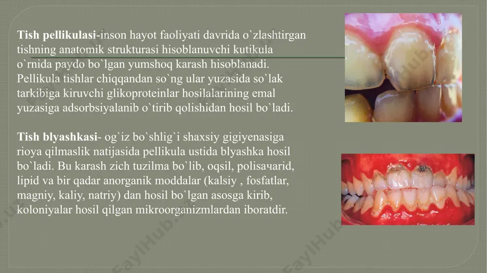 arkbida natriy, rux, stronsiy, brom, mis, volfram, alyuminiy, oltin kabi mikroelemetlar saqlaydi. tish toshlarining organik tarkibi protein-polisaxarid kompleksi, qovjirab tushgan epiteliy, leykotsitlar va mikroorgnizmlardan iborat. milk osti tish toshlari- milk marginal sohasi ostida joylashgan bo`ladi va ularni oddiy ko`zda ko`ra olmaymiz. aniqlashning asosiy usuli zondlash. aniqlangan tish milk osti toshlari odatda qattiq, to`q jigarrang yoki qoramtir-yashil tusda bo`ladi. milk osti toshi tish bo`yin qismini o`rab olishga harakat qiladi va notekis sath hosil qilib tishlarga qattiq yopishgan bo`ladi. kimyoviy va struktura tuzilishi jihatidan milk osti toshlari milk usti toshlariga juda ham o`xshashdir. bular asosan milk suyuqligidan hosil bo`ladi. yumshoq karashlarni tozalash bajariladigan bosqichlar qadamlar: 1. og‘iz bo‘shlig‘i 1% xlorgeksidin eritmasi bilan chayiladi 2. dastakka tabbiy tutamli cho‘tka tozalagichga, gigienik pasta qo‘yib, 10000 ayl/min tezlikda yumshoq tish karashlarni olib tashlanadi. 3. tishning vestibulyar, so‘ng oral yuzalaridan aylanma skanirlangan harakat orqali vizual ko‘rik ostida yumshoq tish karashlari olib tashlanadi. 4. karashlarning tozalanganlik sifatini …