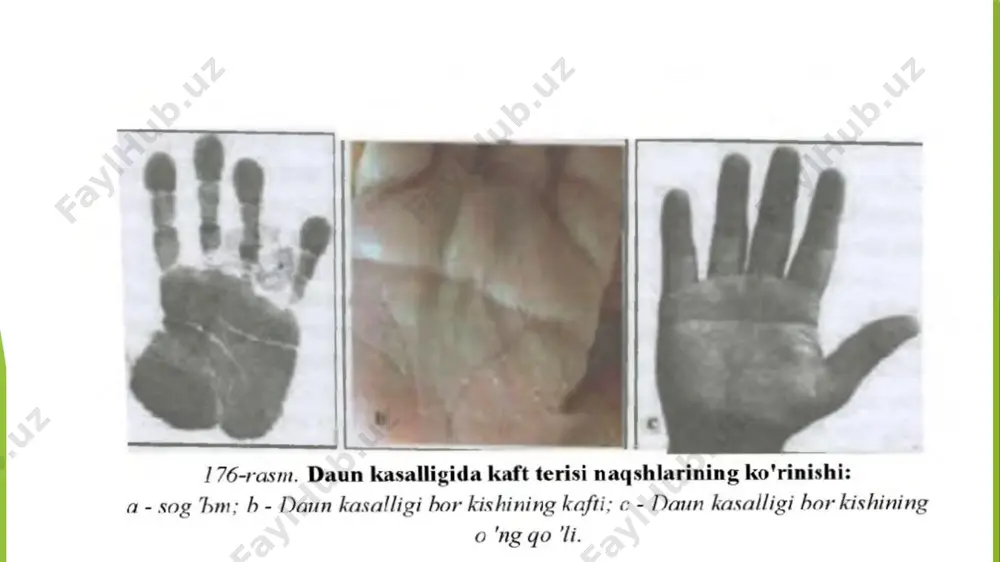 irsiy kasalliklar slaydi - Page 5