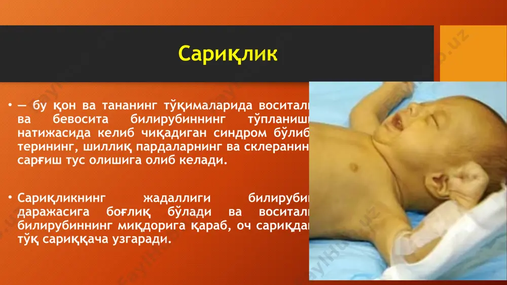 муддатда туғилган чақалоқларнинг 10%да қонида воситали билирубин миқдори 340 мкмоль/лдан ошганда, 30%да қонида 430 мкмоль/лдан ошганида, 70%да - 520 мкмоль/лдан ошганда ривожланади. чгк анемик шакли сариқликнинг анемик шакли кечиж жараёни бўйича энг безарардир. клиник симптомлари: терининг рангпарлиги, анемия, жигар ва талоқнинг катталашиши. воситали билирубин концентрацияси бироз ошган бўлиши мумкин. чгкнинг антенатал диагностикаси - онанинг касаллик тарихи (ўтмишда болани олдириш, ўлик туғиш, хомила тушиб колиши, касал бола туғиш, резус-факторни хисобга олмасдан гемотрансфузия амалга ошириш) - резус манфий аёл конида антирезус антителолар титрини аниклаш - амниоцентез усулида олинган хомила атрофи сувини текшириш - узи текширув чгкнинг постнатал диагностикаси клиник симптомларни кузатиш (сариклик, анемия, гепатоспленомегалия) конда богланмаган билирубин фракциясини ортиши, эритробластоз, ретикулоцитоз, резус конфликтда кумбс пробаси мусбат булиши. консерватив даволаш фототерапия давомида богланмаган билирубин фотооксидланишга учрайди ва терида сувга эрувчан изомерига айланади, у сийдик ва ахлат оркали чикиб кетади экспресс-саволнома чақалоқлар фототерапияси бўйича swot-анализ тузинг. s-кучли томонлари w- заиф томонлари o-имкониятлар t- тўсиқ …