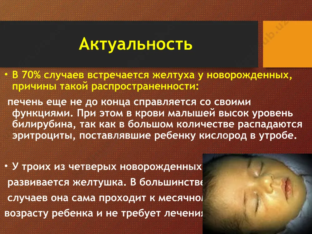 осфатдегидрогеназы (г-6-фд) экспресс-опрос ситуационная задача: у новорожденного 2 степень желтухи. вопрос: 1.какие участки кожи могут быть пожелтевшими? 2.каков уровень билирубина может при этом быть? физиологическая желтуха – транзиторая наблюдается у 86,5% доношенных новорожденных. транзиторная гипербилирубинемия обусловлена ускоренным гемолизом эритроцитов новорожденных, временной незрелостью фермента глюкоуронилтрансферазы. общее состояние ребенка не нарушено. желтушность кожи у ребенка появляется на 2-3 день жизни и исчезает на 10-14 день. количество эритроцитов, размеры печени и селезенки в пределах нормы. лечение: 5% глюкоза или 0,9% раствор натрия хлорида, фототерапия. прогноз благоприятный. коньюгационная желтуха у недоношенных детей носит затяжное течение (4-6 мес), имеет более выраженную картину. клинически желтуха нарастает медленно, при этом гепатомегалия и спленомегалия отсутствуют, кал и моча неокрашены, анемизации нет. в основе желтухи лежит временная незрелость энзимных факторов печени, коньюгирующих и экскретирующих билирубин гемолитическая болезнь новорожденных заболевание в основе которого лежит гемолиз эритроцитов плода и новорожденного связанный с несовместимостью крови матери и плода по эритроцитарным антигенам. этиология: …