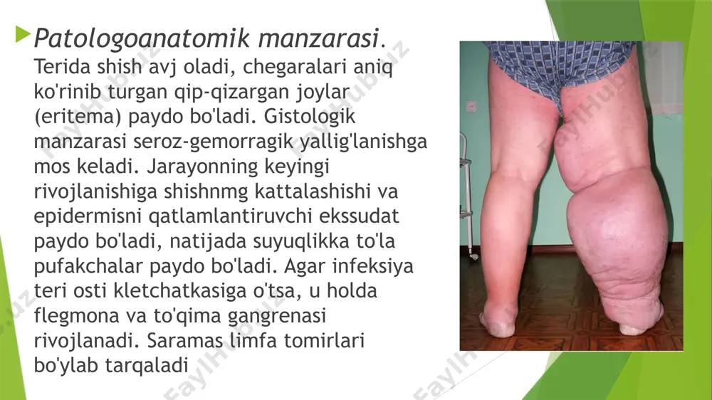 uni sterptotsid mazi yoki sintomitsin emulsiyasi shimdirilgan bog'lov bilan bog'lash zarur. tashxisoti- asosiy klinik ma’lumotlarga ,kasallikning o’tkir boshlanishi, isitma zaxarlanish uzigz xos maxalliy ozgarishlarga asoslanib tashxis quyiladi. taqqoslash tashxisoti asosan terining maxalliy giperimiya bilan kechuvchi kasalligi ;erzipeloid dermatit ekzema tugunchali eritema flegmona abstses va boshqalar bilan o’tkaziladi. saramasni tez-tez qaytalanib turishi limfa tomirlarini obliteratsiyasiga uchratadi va surunkali yallig’lanish turiga sharoit yaratiladi, bunda limfa dimlanib limfademalar-fil oyoq rivojlanadi saramas bilan kasallangan joyni limfa tugunlarida apatogen streptokokk saqlanib qoladi, arzimagan jarohat ham shu streptokokkni patogrnga aylanishi uchun ( qon va to’qima suyuqligi) qulay biologik sharoityaratiladi, demak saramas qaytalanadi asoratlari asorati- jaroxatlangan teri soxasida flegmona, abses nekroz tromboflibit,infeksion toksik karaxtlik, infeksion toksin ensefalit, ikkilamchi pnevmoniya va sepsis kelib chiqishi mumkin. profilaktikasi mikrotravmalarning, sovuq qotishlarning oldini olish, shaxsiy gigiena qoidalariga rioya qilish, terining zamburug’li va yiringli kasalliklarini o‘z vaqtida davolash kasallikning oldini olish negizidir. retsidivlanuvchi shaklini profilaktika qilishda birlamchi kasallanishni o‘z vaqtida davolash va …