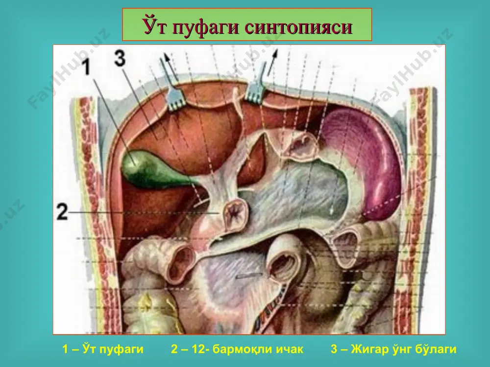 ханик сариқлик, ўткир холангит, ўткир панкреатит ва бошқалар ривожланиши. хасталикнинг субъектив белгилари: ўнг қовурға равоғи остидаги оғриқ, кўнгил айниши, оғизда аччиқ таъм сезгиси, жиғилдон кайнаши, зарда бўлиш, қайт қилиш (қусиш), оғриқларни овқатланишга боғлиқлиги, қориннинг дам бўлиши, оғриқнинг ўнг куракка, белга бериши (иррадиация). ўт хасталигида оғриқ локализацияси ўнг қовурға равоғи остида, эпигастрал соҳада хуруж даври муолажаси: яллиғланиш жараёнини бартараф этиш, спазмолитиклар, инфузион ва детоксикацион муолажа, ўтни ҳайдовчи муолажа, оғриқсизлантириш (аниқ ташхис қўйилгач) сув ва электролитлар мувозанатини тиклаш очлик ва қатъий парҳез қилиш, динамик кузатувни ташкил этиш. диагностика усуллари дуоденал зондлаш, ультратовушли текширув (узи), контраст рентгенография (холецисто-, холангиография), компьютер томография (кт), лапароскопия, ядер-магнитли резонанс томография (ямр), ўт пуфагининг нормал манзараси (узи) 1. ўт қопи бўшлиғи 2. ўт қопи девори 3. ўт қопи йўли 4. жигар тўқимаси ўт пуфагидаги тошлар (узи) холецистография 1. ўт қопи сояси 2. умумий ўт йўли сояси 3. умуртқа поғонаси 4. ковурғалар - организм учун безарар эмас. - беморни …