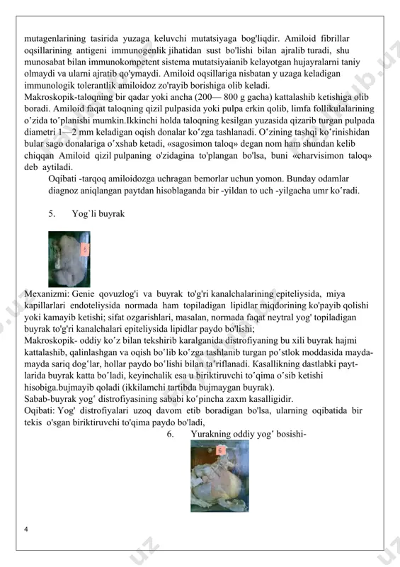 ari qaytmas jarayon bo‛ladi. gialinozning/ funksional ahamiyati uning qayеrda paydo bo‛lgani va nеchog‛lik tarqalganiga bog‛liq 4.sagosimon taloq amiloidoz (yunoncha amylium kraxmal, degan so'zdan olingan) eng og‘ir stroma-tomir distrofiyasi jumlasiga kiradi va oqsillar almashinuvining ko`p darajada buzilishi bilan birga davom etib boradi. sabab-1) fibrillyar oqsilning sintеzida irsiy nuqson borligi;2) yiringli dеstruktiv jarayonlar bilan o‛tadigan surunkali infеksiyalar (sil, bronхoektatik kasallik, ostеomiеlit);3) moddalar almashinuvida odamning yoshiga qarab bo‛ladigan o‛zgarishlar;4) immunositlar diskraziyasi (β-hujayralar o‛smasida kuzatiladigan rhujayra diskraziyasi), miеloma kasalligi, nodulyar limfoma, immunoblastik limfadеnopatiya mexanizmi: mutatsion nazariyaga muvofiq (v. v. serov, i. a. shamov, 1977), amiloidoblastlar klonining paydo bo'lishi uzoq davom etadigan antigenlar tasirida, o`sma mutagenlarining tasirida yuzaga keluvchi mutatsiyaga bog'liqdir. amiloid fibrillar oqsillarining antigeni immunogenlik jihatidan sust bo'lishi bilan ajralib turadi, shu munosabat bilan immunokompetent sistema mutatsiyaianib kelayotgan hujayralarni taniy olmaydi va ularni ajratib qo'ymaydi. amiloid oqsillariga nisbatan y uzaga keladigan immunologik tolerantlik amiloidoz zo'rayib borishiga olib keladi. makroskopik-taloqning bir qadar yoki ancha (200— …