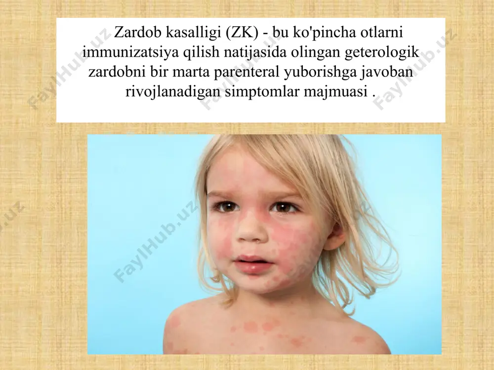 imiy bo'lib qoladi, bu protein katabolizmining intensivligini aks ettiradi. uchinchi bosqich antigenning qon oqimidan yo'qolishining yuqori tezligi bilan tavsiflanadi , bu antigenning antikorlar bilan bog'lanishining natijasidir, shuning uchun bu bosqich "antigenni yo'q qilishning immun bosqichi" deb nomlangan. zk rivojlanishida ishtirok etadigan antikorlar igg sinfiga kiradi va igm . e.i.karavayev zk bilan og'rigan bemorlarda terini sezgirlashtiruvchi antitellarni o'rganib chiqdi va reaginlar zkda majburiy emasligini va patogenezda etakchi rol o'ynamasligini ko'rsatdi . zk sindromi antigen-antikor immun komplekslariga ta'sir qilish natijasida yuzaga keladigan reaktsiya turiga ishora qiladi. to'qimalarning shikastlanishi o'z ichiga oladi komplement omili , klazkik turga ko'ra immun kompleksi shakllanish vaqtida faollashadi. immunofluoresans tadqiqotlari lezyonlarda to'qimalarni leykotsitlar kimyotaksisi, shuningdek, eksteraza ta'siri bilan yuqtiradi, deb ishoniladi . qon oqimidagi immun komplekslarning shakllanishi vazoaktiv moddalarning chiqarilishiga olib keladi va kinin tizimi faollashadi . o'tkir zardob kasalligida buzilishlar cho'kma bilan bog'liq buyrak glomerulyar tomirlari devorlari bo'ylab va ichida eruvchan immun komplekslar . glomeruli ko'pincha shikastlanadi …